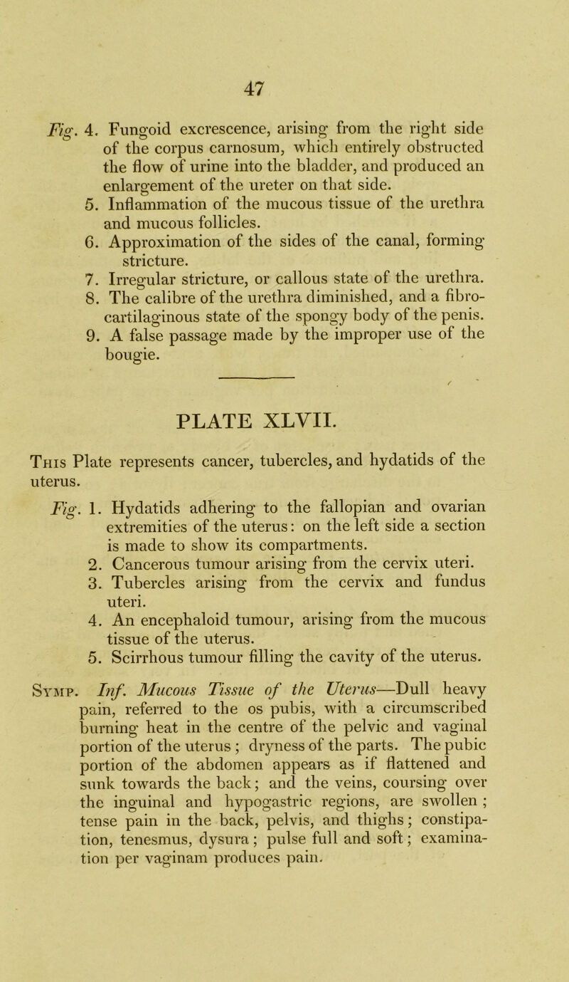 Fiy g. 4. Fungoid excrescence, arising from the right side of the corpus carnosum, which entirely obstructed the flow of urine into the bladder, and produced an enlargement of the ureter on that side. 5. Inflammation of the mucous tissue of the urethra and mucous follicles. 6. Approximation of the sides of the canal, forming stricture. 7. Irregular stricture, or callous state of the urethra. 8. The calibre of the urethra diminished, and a fibro- cartilaginous state of the spongy body of the penis. 9. A false passage made by the improper use of the bougie. PLATE XLVII. This Plate represents cancer, tubercles, and hydatids of the uterus. Fig. 1. Hydatids adhering to the fallopian and ovarian extremities of the uterus: on the left side a section is made to show its compartments. 2. Cancerous tumour arising from the cervix uteri. 3. Tubercles arising from the cervix and fundus uteri. 4. An encephaloid tumour, arising from the mucous tissue of the uterus. 5. Scirrhous tumour filling the cavity of the uterus. Symp. Inf. Mucous Tissue of the Uterus—Dull heavy pain, referred to the os pubis, with a circumscribed burning heat in the centre of the pelvic and vaginal portion of the uterus ; dryness of the parts. The pubic portion of the abdomen appears as if flattened and sunk towards the back; and the veins, coursing over the inguinal and hypogastric regions, are swollen ; tense pain in the back, pelvis, and thighs; constipa- tion, tenesmus, dysura ; pulse full and soft; examina- tion per vaginam produces pain.