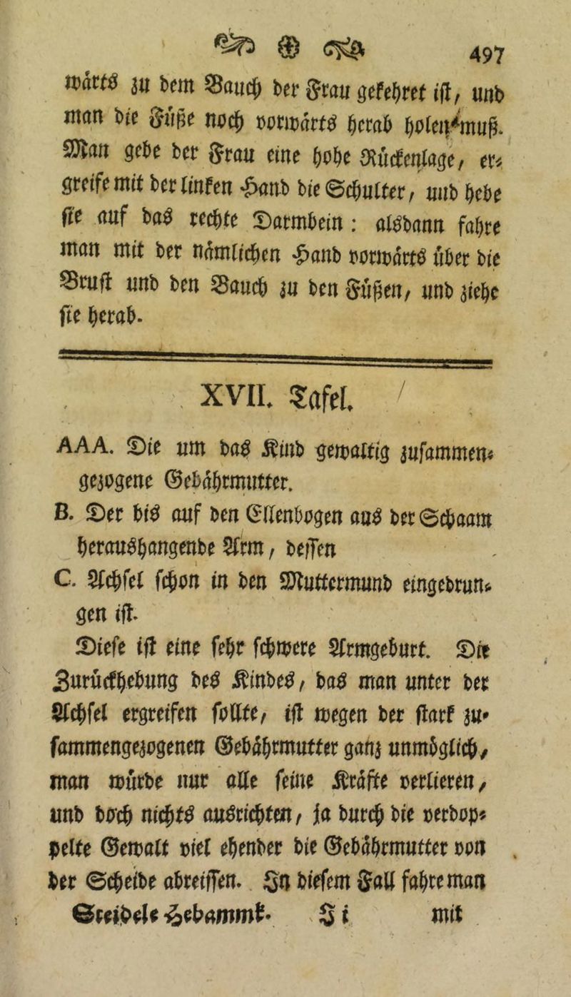 3u bcm Saiid^ ber Srau 9efe()re( (fl, unb «tan bre Sm no^ bcmb 9}lan gebe ber grau eine bobe ^ücbenlage, er^ greife tttit berliufen -^aub bie©(^u(ter/ uub bebe fte auf m tecb^e Darmbein: at^bann fahre man mit ber ndmticben «£>anb bormdrt^ über bie Srufl unb ben Saueb au ben Sufäeu/ unb aiebc fie berab. XVIL 5afeL / , AAA. Die um ba^ Äinb gemattig jufammen« gezogene ©ebdbrmutter. B. Der bi^ auf ben ^aenbagen au^ ber@cbaam berou^böngenbe 5frm, beffen 1 C. Sfebfet febbu in ben 2}tuttermunb eingebrun«. gen ifr Diefe tft eine febr febmere Sfrmgeburt. Die Suruefbebung M Äinbe^ ^ ba^ man unter ber $tcbfel ergreifen foUtC/ ifl megen ber flarf au^ fammengeapgenen ©ebdbrmutter gana unmbgticb/ man mürbe nur aKe feine grafte verlieren/ nnb bireb nieb^^ auöricbteit/ ja bureb bie rerbup« pelte Gewalt t>iel ebenber bie ©ebdbrmutter bpn ber ©cbeibe abreiffem Sn biefem galj fahre man iebammt- ^ S i rnit