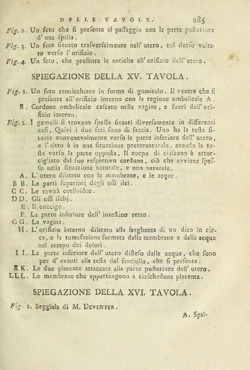 Fig. ì. Un feto che fi prefenta al patteggio con la parte pofteriore d’ una /palla . Fig. 3. Un feto finiate trafverfalcnente nell’utero, col dorfo volta- to verfo f orifizio. Fig. 4, Un feto, che prefenta le natiche all’orifizio dell’utero. SPIEGAZIONE DELLA XV. TAVOLA. Fig- 1. Un feto rannicchiato in forma di gomitolo. 11 ventre che fi prefenta all’orifizio interno con la regione ombelicale A, B . Cordone ombelicale cafcato nella vagina , e fuori dell’ ori- fizio interno. Fig. 2. I gemelli fi trovano fpeSTo fituati diverfamente in differenti cafi. Quivi i due feti fono di faccia. Uno ha la teda fi- tuata convenevolmente verfo la parte inferiore dell’utero, e 1’ altro è in una lunazione preternaturale, avendo la te- tta verfo la parte oppofta. Il corpo di ciafcuno è attor- cigliato dai fuo refpétcivo cordone , ciò che avviene fp e fi- fe nella fituazione naturale, e non naturale. A. L’utero dilatato con le membrane, e le acque., B B. Le parti fuperiori degli offl ilei, C C. Le cavità cotiloldee . D D . Gli otti ifchj. E . Il coccige . F. La parte inferiore dell’ insedino retto. G G . La vagina, H. L’ orifizio interno dilatato alla larghezza di un dito in cir- ca, e la tumefazione formata dalle membrane e dalie acque nel tempo dei dolori. I I. La parte inferiore dell’utero diftefo dalle acque, che fona per d’ avanti alla tetta del fanciullo, che fi prefenta . K K. Le due placente attaccate afta parte pofteriore dell’utero. LLL. Le membrane che appartengono a ciafcheduna placenta. SPIEGAZIONE DELLA XVI. TAVOLA * Fìg. i. Seggiola di M. Deventer. A» Spai-