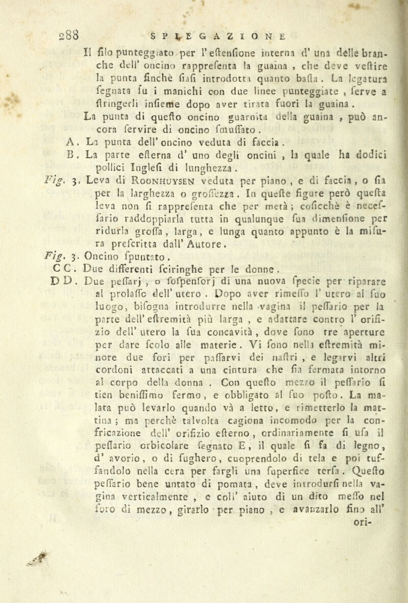 II filo punteggiato per fedendone interna d’ una delle bran- che dell* oncino rapprefenta la guaina , che deve veftire ìa punta finché fiali introdotti quanto bada. La legatura Legnata fu i manichi con due linee punteggiate , ferve a fìringerli indeme dopo aver tirata fuori la guaina . La punta di quedo oncino guarnita della guaina , può an- cora fervire di oncino denudato . A. La punta dell* oncino veduta di faccia . B. La parte edema d’ uno degli oncini , la quale ha dodici pollici Xngìed di lunghezza. Fìg. 3, Leva di P^oonhuysen veduta per plano , e di faccia, o da per la larghezza o grodezza . In quede figure però queda leva non fi rapprefenta che per metà ; codcchè è necef- iario raddoppiarla tutta in qualunque fu a dimenfione per ridurla grolla , larga, e lunga quanto appunto è la mifu- ra preferita dall’Autore. Fìg, 3. Oncino fpuntsto. C C . Due differenti feiringhe per le donne . D D. Due peffarj , o fofpenforj di una nuova fpecie per riparare al prolaffc dell’ utero . Dopo aver rimeffo V utero al fuo luogo, bifogna introdurre nella vagina il pedano per la parte dell’edremità più larga , e adattare contro l’orifi- zio dell’ utero la fua concavità , dove fono tre aperture per dare fcolo alle materie . Vi fono nella edremità mi- nore due fori per padarvi dei nadri , e legarvi altri cordoni attaccati a una cintura che fin fermata intorno al corpo della donna . Con quedo mezzo il peffario fi tiers beniffimo fermo, e obbligato al fuo pedo. La ma- lata può levarlo quando va a letto, e rimetterlo la mat- tina ; ma perchè talvolta cagiona incomodo per la con- fricazione dell’ orifizio ederno , ordinariamente fi ufa il pedario crbicolare fegnato E, il quale fi fa di legno, d’ avorio, o di fugherò, cuoprendolo di tela e poi tuf- fandolo nella cera per fargli una fuperfiee terfa . Quedo pefiario bene untato di pomata , deve introdurli nella va- gina verticalmente , e coll’ aiuto di un dito meffo nel foro di mezzo, girarlo per piano , e avanzarlo finn all* ori-