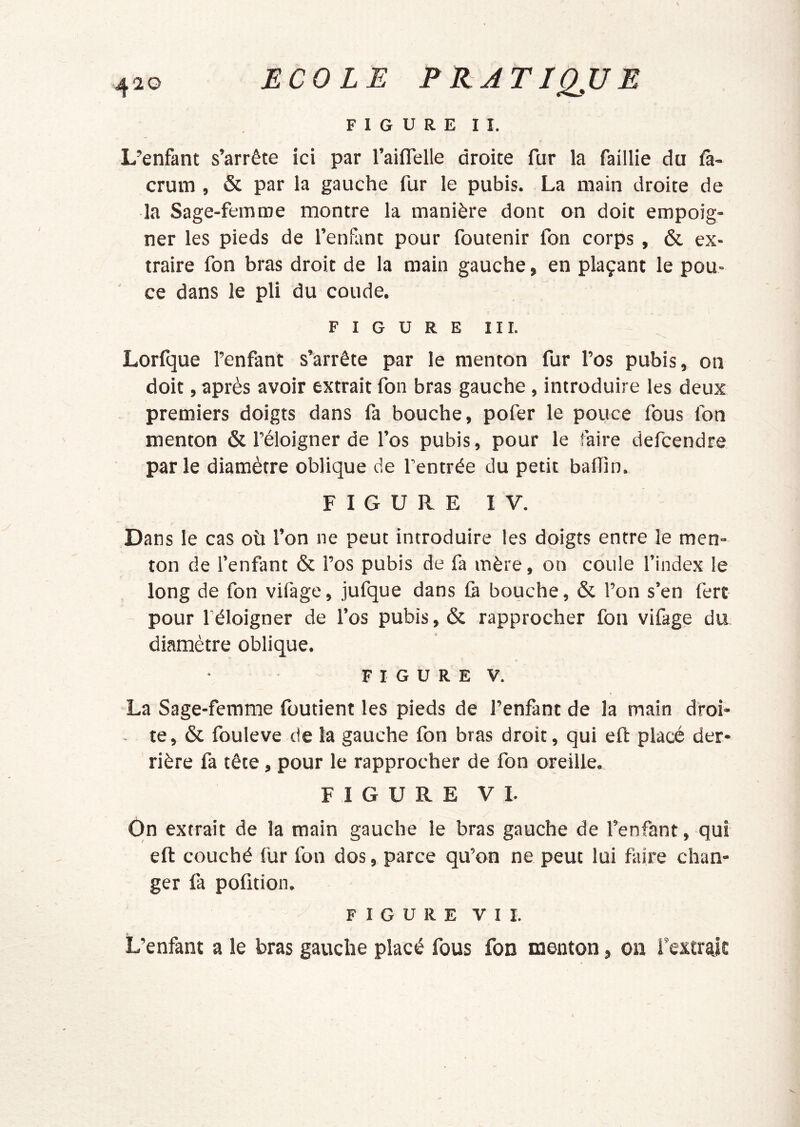 FIGURE II. L’enfant s’arrête ici par l’aiflelle droite fur la faillie du fà- crum , & par la gauche fur le pubis. La main droite de la Sage-femme montre la manière dont on doit empoig- ner les pieds de l’enfant pour foutenir fon corps , & ex- traire fon bras droit de la main gauche, en plaçant le pou- ce dans le pli du coude. FIGURE III. Lorfque l’enfant s’arrête par le menton fur l’os pubis, on doit, après avoir extrait fon bras gauche, introduire les deux premiers doigts dans fa bouche, pofer le pouce fous fon menton & l’éloigner de l’os pubis, pour le faire defcendre parle diamètre oblique de l’entrée du petit baffin. FIGURE IV. Dans le cas où l’on ne peut introduire les doigts entre le men- ton de l’enfant & l’os pubis de fa mère, on coule l’index le long de fon vifage, jufque dans fà bouche, & l’on s’en fert pour l’éloigner de l’os pubis, & rapprocher fon vifage du diamètre oblique. F I G U R E V. La Sage-femme foutient les pieds de l’enfant de la main droi- . te, & fouleve de la gauche fon bras droit, qui eft placé der- rière fa tête, pour le rapprocher de fon oreille. FIGURE VI. On extrait de la main gauche le bras gauche de l’enfant, qui eft couché fur fon dos, parce qu’on ne peut lui faire chan- ger fa pofition. FIGURE VII. L’enfant a le bras gauche placé fous fon menton, on Textraic