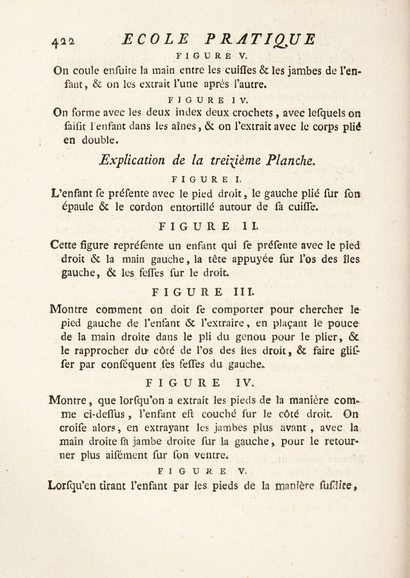 FIGURE V. On coule enfuite la main entre les cuiffès & les jambes de l’en- fanc, & on les extrait l’une après l’autre. FIGURE IV. On forme avec les deux index deux crochets, avec lefquels on faifit l'enfant dans les aînés, & on l’extrait avec le corps plié en double. Explication de la treiiième Planche, FIGURE I. L’enfant fe préfente avec le pied droit, le gauche plié fur fbn épaule ôc le cordon entortillé autour de fa cuiffe. FIGUREII. Cette figure repréfente un enfimt qui fe préfente avec le pied droit & la main gauche, la tête appuyée fur l’os des îles gauche, & les felTes fur le droit. FIGURE III. Montre comment on doit fe comporter pour chercher le pied gauche de l’enfant & l’extraire, en plaçant le pouce de la main droite dans le pli du genou pour le plier, & le rapprocher du- côté de l’os des fies droit, & faire glif- fer par conféquent fes felTes du gauche.. FIGURE IV. Montre, que lorfqu’on a extrait les pieds de la manière com* me ci-deflus, l’enfant eft couché fur le côté droit. Gn croife alors, en extrayant les jambes plus avant , avec la main droite fa jambe droite fur la gauche, pour le retour- ner plus aifément fur fon ventre, FIGURE V. Lorfqu’en tirant l’enfant par les pieds de la manière fufiite.