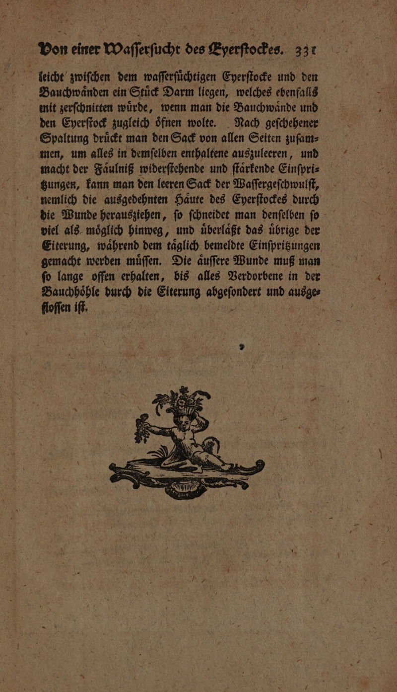leicht zwifchen dem waſſerſüchtigen Eyerſtocke und den Bauchwaͤnden ein Stuͤck Darm liegen, welches ebenfalls mit zerſchnitten würde, wenn man die Bauchwaͤnde und den Eyerſtock zugleich oͤfnen wolte. Nach geſchehener Spaltung druͤckt man den Sack von allen Seiten zufam⸗ men, um alles in demſelben enthaltene auszuleeren, und macht der Faͤulniß widerſtehende und ſtaͤrkende Einſpri⸗ tzungen, kann man den leeren Sack der Waſſergeſchwulſt, nemlich die ausgedehnten Haͤute des Eyerſtockes durch die Wunde herausziehen, fo ſchneidet man denſelben fo viel als moͤglich hinweg, und uͤberlaͤßt das uͤbrige der Eiterung, waͤhrend dem taͤglich bemeldte Einſpritzungen gemacht werden muͤſſen. Die aͤuſſere Wunde muß man ſo lange offen erhalten, bis alles Verdorbene in der Bauchhöhle ie die Eiterung en und nee. floſſen iſt.