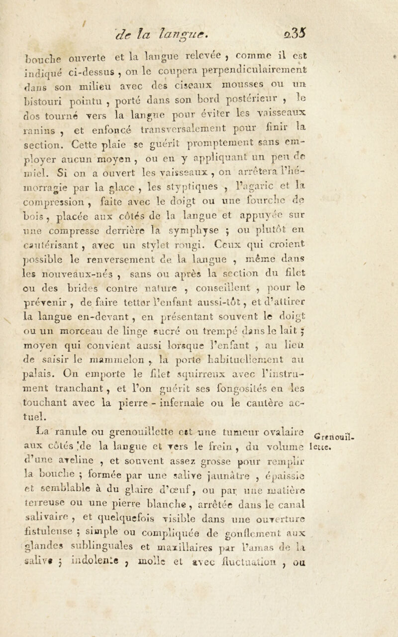 / de la langue. ai5 b ou clie ouverte et la langue relevée , comme il est indiqué ci-dessus , on le coupera perpendiculairement dans son milieu avec des ciseaux mousses ou un bistouri pointu , porté dans son bord posteriem > le dos tourné vers la langue pour éviter les vaisseaux ranins , et enfoncé transversalement pour finir la section. Cette plaie se guérit promptement sans em- ployer aucun moyen , ou en y appliquant un peu de miel. Si on a ouvert les vaisseaux , on arrêtera îHé- morragie par la glace , les styptiques , l’agaric et la compression , faite avec le doigt ou une fonrebe de Lois , placée aux côtés de la langue et appuyee sur une compresse derrière la symphyse 5 ou plutôt en cautérisant , avec un stylet rougi. Ceux qui croient possible le renversement de la langue , même dans les nouveâux-nés , sans ou après la section du filet ou des brides contre nature , conseillent , pour le prévenir, défaire tettor l’enfant aussi-tôt, et d’attirer la langue en-devant , en présentant souvent le doigt ou un morceau de linge sucré ou trempé dans le lait J moyen qui convient aussi lorsque î’enfant , au lieu de saisir le mammelon ,. la porte habituellement au palais. On emporte le filet squirreux avec l’instru- ment tranchant , et l’on guérit ses fongosités en les touchant avec la pierre - infernale ou le cautère ac- tuel. La ranule ou grenouillette e*t une tumeur ovalaire aux côtés 'de la langue et vers le frein , du volume d’une aveline , et souvent assez grosse pour remplir la bouche ; lormée par une salive jaunâtre , épaissie et semblable à du glaire d’œuf, ou par une matière terreuse ou une pierre blanche , arretée dans le canal salivaire , et quelquefois visible dans 1111e ouverture fistuieuse ; simple ou compliquée de gonflement aux glandes sublinguales et maxillaires par l’amas de la salivt j indolence ? molle et avec fluctuation , ou Grenouil- Ieue.