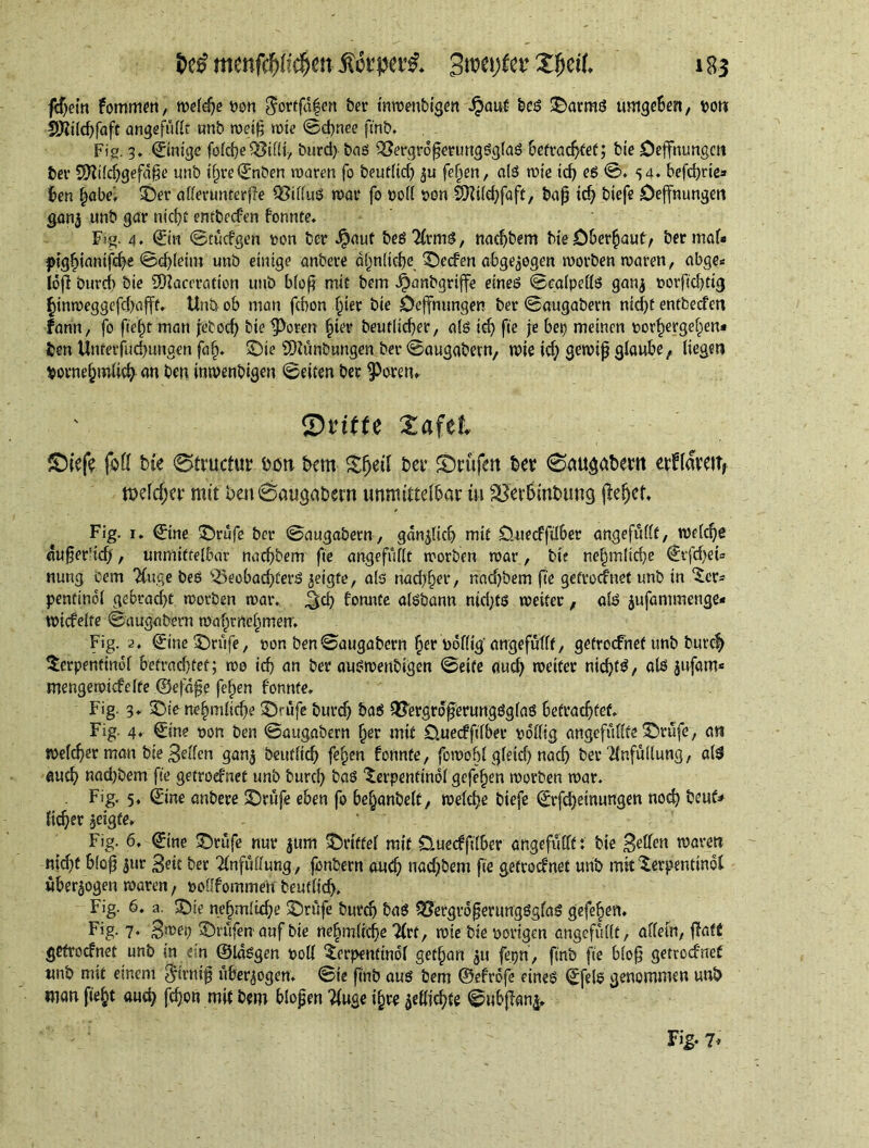 fdjein fommen, welche yon $ortfdfen her inwenbigen Jjrnut bes Sarms umgeben, yon SKilchfaft angefuflt unb weip rote ©d)nee finb. Fig. 3. ©inige folche TSifli, burd) bas T&rgroflerungSglaS Befrachtet; bie öeffnungen ber SOlilchgefdpe unb if)re©nben waren fo beuflid) ju fepen, als wie ich eS ©. 5 4. befehrie* Ben habe^ Ser alferunterfle Q?tiiuö war fo »ok yon 2Kild)faft, bap td) biefe Oeffnungen gan$ unb gar nicht embeef'en fonnte. Fig. 4. ©in ©tucfgen yon ber Jpauf beS^lrmS, nachbem bieDBerpaut, ber mal« pighianifehe ©dfletm unb einige anbere dienliche Secfen abgelegen worben waren, abge« Ibjl burd) bie Skaecrafion unb blop mit bem J^anbgrijfe eines ©ealpells ganj yorfid)tig ^inweggefdrafff. Unb, ob man fchon hier bie jöeffnungen ber ©augabern nicf>c entfcecfen fann, fo fiept man jeboch biederen pier beutlicher, als ich fle )e Bei) meinen yorpergepen* ben Unterjuchungen fap. Sie üftünbungen ber ©augabern, wie id; gewtp glaube, liegen vornehmlich an ben inwenbigen ©eiten ber $sren. dritte Xafet foil bie ©tructup döu bem Shell ber Prüfen hex ©augabern etflavett; welcher mit beit ©augabern unmittelbar tu SJerbinbung flehet, Fig. r. ©ine Abrufe ber ©augabern, ganjlich mit CUiecffüBer angefuflt, welche auper'id)' / unmittelbar nachbem fie angefuflt worben war, bie nepmliche €rfd)ei= nuttg bem %uge bes T5eo Baxters geigte, als nad;|er, nad)bem fie getroefnet unb in Ser* pentinol gebracht worben war. ^d) fonnte aisbann nichts weiter, als jufammenge* wtcfelre ©augabern wahrrtehmen. Fig. ©ine Stufe, yon ben ©augabern her bdflig' angefuflt, getroefnet unb burd) Terpentinöl Befrachtet; wo ich an ber auswenbigen ©eite aud) weiter nichts, als jufam* mengeroicfelte ©efdpe fe^en fonnte, Fig. 3, Sie nehmliche Srufe burch bas Q&rgrdperungSglaö Befrachtet, Fig. 4, ©ine yon ben ©augabern her mit üueeffifbet yoflig angefüllte Stufe, an welcher man bie gellen ganj beuflich fehen fonnte, fowohl gletd) nach ber Knfüllung, als auch nad)bem fie getroefnet unb burch baö Terpentinöl gefeiten worben war. Fig. 5, ©ine anbere Srufe eben fo Behanbelf, welche biefe ©rfd)einungen noch beut* lid)er geigte, Fig. 6. ©ine Srufe nur $um Sriffel mit Üuecffilber angefuflt: bie Sellen waren m’d)f Blop $ur Seit ber 2lnfuflung, fonbern auch nadjbem fie getroefnet unb mit Terpentinöl «Bezogen waren, yoflfommen beutlich, Fig. 6. a. Sie nef)m!td)e Srufe burch bas QSergrdperungSgfaS gefepen. Fig. 7‘ Swep Stufen- auf bie nepmlicfje 2lrf, wie bie vorigen angefuflt, allem, flaft getroefnet unb in ein ©Idsgen yofl Terpentinöl getpan ju ferm, finb fie Blop getroefnet «nb mit einem $irnip überzogen, ©te pnb aus bem ©efrbfe eines ©fels genommen unb man fieht auch ftps« mit bem Blopen ?luge ihre pflichte ©ubpan^