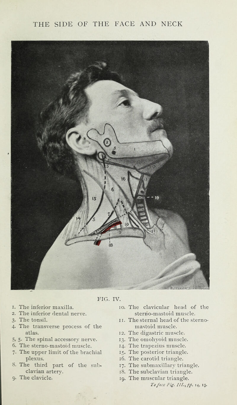 FIG. IV. 1. The inferior maxilla. 2. The inferior dental nerve. 3. The tonsil. 4. The transverse process of the atlas. 5. 5. The spinal accessory nerve. 6. The sterno-mastoid muscle. 7. The upper limit of the brachial plexus. 8. The third part of the sub- clavian artery, 9. The clavicle. 10. The clavicular head of the sterno-mastoid muscle. 11. The sternal head of the sterno- mastoid muscle. 12. The digastric muscle. 13. The omohyoid muscle. 14. The trapezius muscle. 15. The posterior triangle. 16. The carotid triangle. 17. The submaxillary triangle. 18. The subclavian triangle. 19. The muscular triangle.