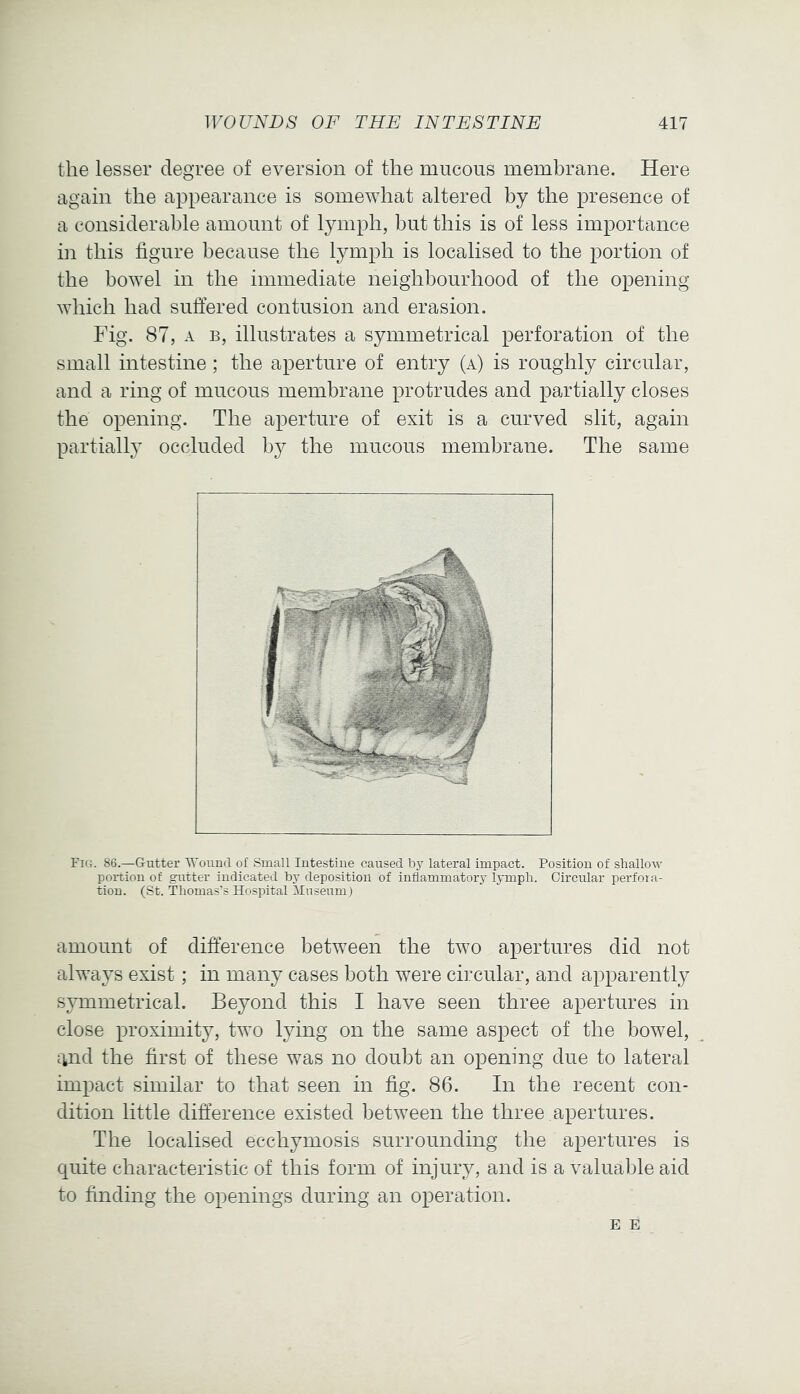 the lesser degree of eversion of the mucous membrane. Here again the appearance is somewhat altered by the presence of a considerable amount of lymph, but this is of less importance in this figure because the lymph is localised to the portion of the bowel in the immediate neighbourhood of the opening which had suffered contusion and erasion. Fig. 87, A B, illustrates a symmetrical perforation of the small intestine; the aperture of entry (a) is roughly circular, and a ring of mucous membrane protrudes and partially closes the opening. The aperture of exit is a curved slit, again partially occluded by the mucous membrane. The same Fig. 86.—Gutter Wound of Small Iiitestiue caused bj' lateral impact. Position of shallow portion of gutter indicated by deposition of inflammatory lymph. Circular perfora- tion. (St. Thomas’s Hospital Wnseum) amount of difference between the two apertures did not always exist; in many cases both were circular, and apparently symmetrical. Beyond this I have seen three apertures in close proximit}^ Bvo lying on the same aspect of the bowel, find the first of these was no doubt an opening due to lateral impact similar to that seen in fig. 86. In the recent con- dition little difference existed between the three apertures. The localised ecchymosis surrounding the apertures is quite characteristic of this form of injury, and is a valuable aid to finding the openings during an operation. E E