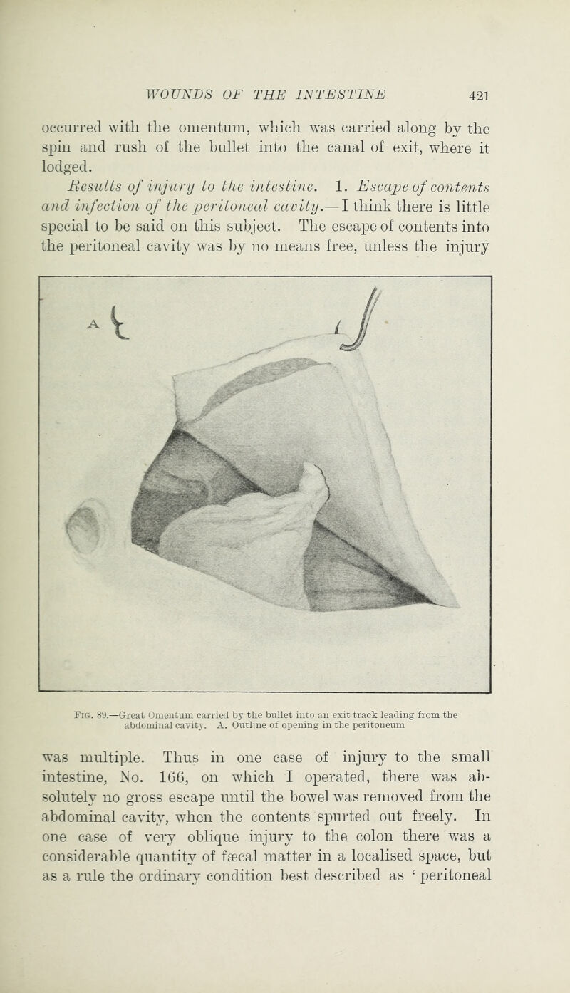 occurred with the omentum, which was carried along by the spin and rush of the bullet into the canal of exit, where it lodged. Besidts of injur ij to the intestine. 1. Escape of contents and infection of the peritoneal cavity.— I think there is little special to be said on this subject. The escape of contents into the peritoneal cavity was by no means free, unless the injury Fig. 89.—Great Omentum carried by the bullet into an exit track leading from the abdominal cavity. A. Outline of opening in the peritoneum was multiple. Thus in one case of injury to the small intestine. No. 166, on which I operated, there was ab- solutely no gross escape until the bowel was removed from the abdominal cavity, when the contents spurted out freely. In one case of very oblique injury to the colon there was a considerable quantity of faecal matter in a localised space, but as a rule the ordinary condition best described as ‘ peritoneal