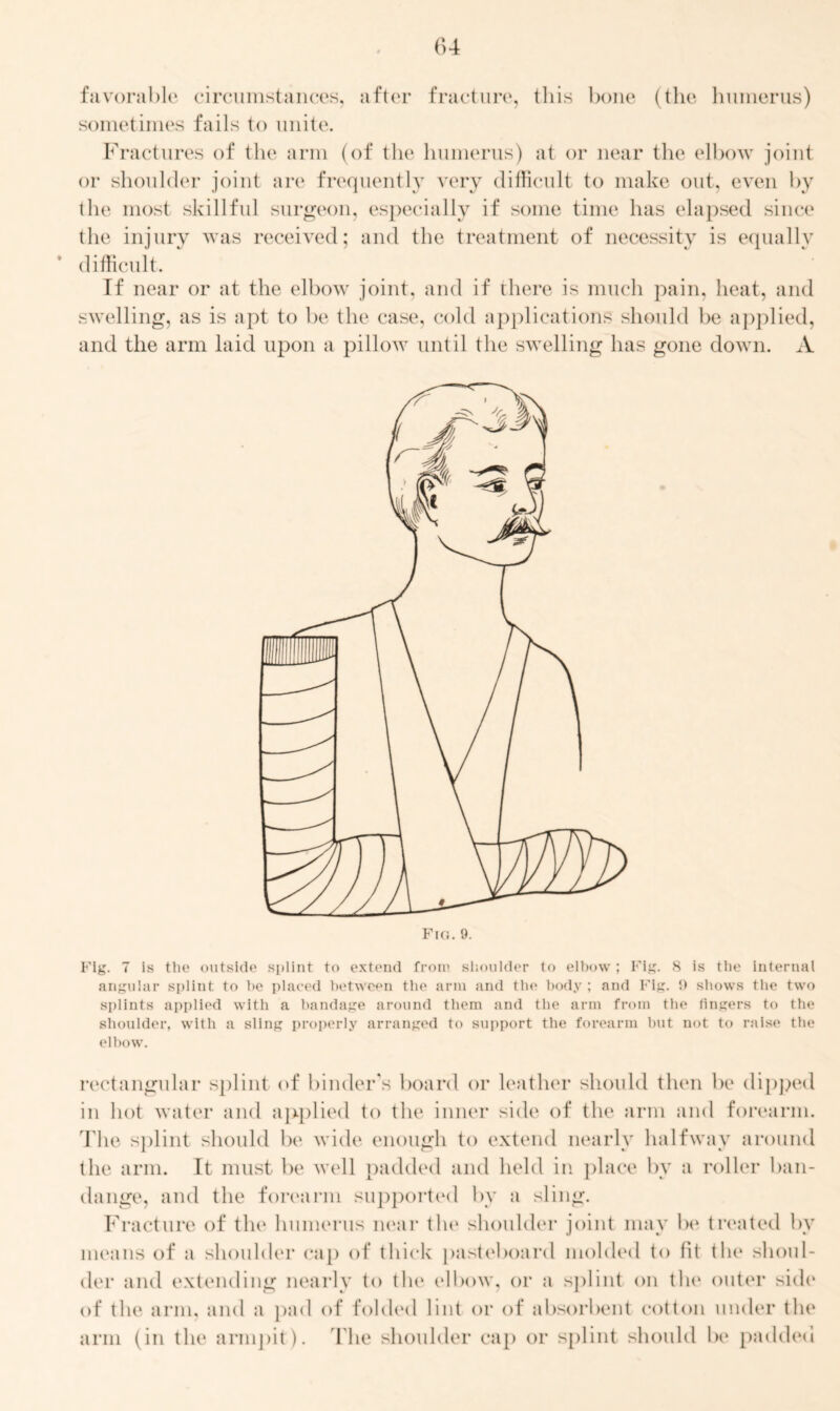 favorable circumstances, after fracture, this bone (the humerus) sometimes fails to unite. Fractures of the arm (of the humerus) at or near the elbow joint or shoulder joint are frequently very difficult to make out, even by the most skillful surgeon, especially if some time has elapsed since the injury was received; and the treatment of necessity is equally difficult. If near or at the elbow joint, and if there is much pain, heat, and swelling, as is apt to be the case, cold applications should be applied, and the arm laid upon a pillow until the swelling has gone down. A Fig. 7 is the outside splint to extend from shoulder to elbow ; Fig. 8 is the internal angular splint to be placed between the arm and the body ; and Fig. !) shows the two splints applied with a bandage around them and the arm from the fingers to the shoulder, with a sling properly arranged to support the forearm hut not to raise the elbow. rectangular splint of binder’s board or leather should then be dipped in hot water and applied to the inner side of the arm and forearm. Hie splint should be wide enough to extend nearly halfway around the arm. It must be well padded and held in place by a roller ban- dange, and the forearm supported by a sling. Fracture of the humerus near the shoulder joint may be treated by means of a shoulder cap of thick pasteboard molded to fit the shoul- der and extending nearly to the elbow, or a splint on the outer side of the arm, and a pad of folded lint or of absorbent cotton under the arm (in the armpit). The shoulder cap or splint should be padded