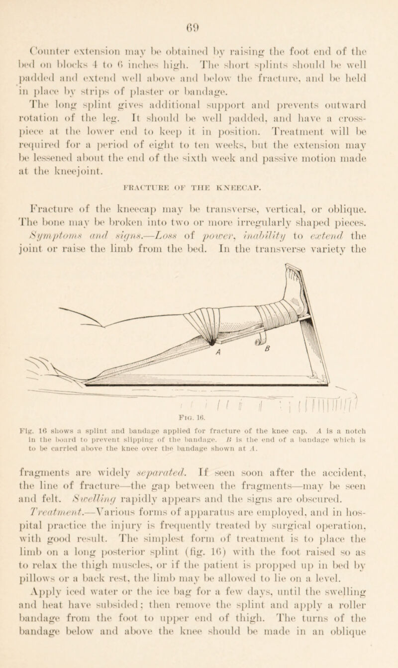 bed on blocks 4 to (*> inches 11i<jfli. The short splints should be well padded and extend well above and below the fracture, and be held in place by strips of plaster or bandage. The long splint gives additional support and prevents outward rotation of the leg. It should be well padded, and have a cross- piece at the lower end to keep it in position. Treatment will be required for a period of eight to ten weeks, but the extension may be lessened about the end of the sixth week and passive motion made at the kneejoint. FRACTURE OF THE KNEECAP. Fracture of the kneecap may be transverse, vertical, or oblique. 'File bone may be broken into two or more irregularly shaped pieces. Symptom* and signs.—Loss of power, inahility to extend the joint or raise the limb from the bed. In the transverse variety the Fig. 10 shows ;i splint and bandage applied for fracture of the knee cap. A is a notch in tlic board to prevent slipping of the bandage. It is the end of a bandage which is to be carried above the knee over the bandage shown at .1. fragments are widely separated. If seen soon after the accident, the line of fracture—the gap between the fragments—may be seen and felt. Swelling rapidly appears and the signs are obscured. Treatment,—Various forms of apparatus are employed, and in hos- pital practice the injury is frequently treated by surgical operation, with good result. The simplest form of treatment is to place tin* limb on a long posterior splint (fig. 1(>) with the foot raised so as to relax the thigh muscles, or if tin* patient is propped up in bed by pillows or a back rest, the limb may be allowed to lie* on a level. Apply iced water or tin* ice bag for a few days, until the swelling and heat have subsided; then remove the splint and apply a roller bandage from the foot to upper end of thigh. The turns of the bandage below and above the knee should be made in an oblique