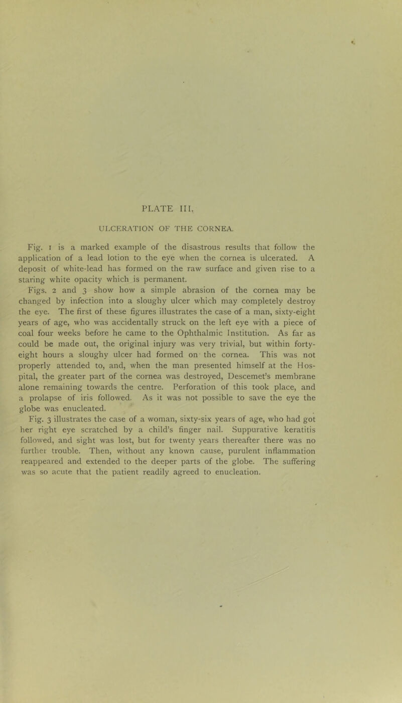 PLATE III. ULCERATION OF THE CORNEA. Fig. I is a marked example of the disastrous results that follow the application of a lead lotion to the eye when the cornea is ulcerated. A deposit of white-lead has formed on the raw surface and given rise to a staring white opacity which is permanent. Figs. 2 and 3 show how a simple abrasion of the cornea may be changed by infection into a sloughy ulcer which may completely destroy the eye. The first of these figures illustrates the case of a man, sixty-eight years of age, who was accidentally struck on the left eye with a piece of coal four weeks before he came to the Ophthalmic Institution. As far as could be made out, the original injury was very trivial, but within forty- eight hours a sloughy ulcer had formed on the cornea. This was not properly attended to, and, when the man presented himself at the Hos- pital, the greater part of the cornea was destroyed, Descemet’s membrane alone remaining towards the centre. Perforation of this took place, and a prolapse of iris followed. As it was not possible to save the eye the globe was enucleated. Fig. 3 illustrates the case of a woman, sixty-six years of age, who had got her right eye scratched by a child’s finger nail. Suppurative keratitis followed, and sight was lost, but for twenty years thereafter there was no further trouble. Then, without any known cause, purulent inflammation reappeared and extended to the deeper parts of the globe. The suffering was so acute that the patient readily agreed to enucleation.