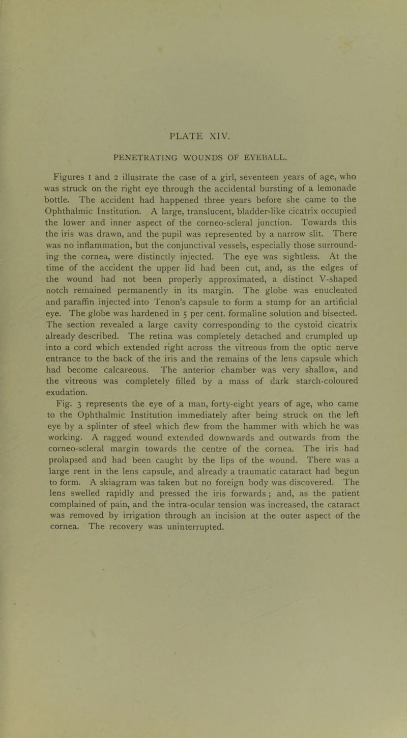 PENETRATING WOUNDS OF EYEBALL. Figures i and 2 illustrate the case of a girl, seventeen years of age, who was struck on the right eye through the accidental bursting of a lemonade bottle. The accident had happened three years before she came to the Ophthalmic Institution. A large, translucent, bladder-like cicatrix occupied the lower and inner aspect of the corneo-scleral junction. Towards this the iris was drawn, and the pupil was represented by a narrow slit. There was no inflammation, but the conjunctival vessels, especially those surround- ing the cornea, were distinctly injected. The eye was sightless. At the time of the accident the upper lid had been cut, and, as the edges of the wound had not been properly approximated, a distinct V-shaped notch remained permanently in its margin. The globe was enucleated and paraffin injected into Tenon’s capsule to form a stump for an artificial eye. The globe was hardened in 5 per cent, formaline solution and bisected. The section revealed a large cavity corresponding to the cystoid cicatrix already described. The retina was completely detached and crumpled up into a cord which extended right across the vitreous from the optic nerve entrance to the back of the iris and the remains of the lens capsule which had become calcareous. The anterior chamber was very shallow, and the vitreous was completely filled by a mass of dark starch-coloured exudation. Fig. 3 represents the eye of a man, forty-eight years of age, who came to the Ophthalmic Institution immediately after being struck on the left eye by a splinter of steel which flew from the hammer with which he was working. A ragged wound extended downwards and outwards from the corneo-scleral margin towards the centre of the cornea. The iris had prolapsed and had been caught by the lips of the wound. There was a large rent in the lens capsule, and already a traumatic cataract had begun to form. A skiagram was taken but no foreign body was discovered. The lens swelled rapidly and pressed the iris forwards ; and, as the patient complained of pain, and the intra-ocular tension was increased, the cataract was removed by irrigation through an incision at the outer aspect of the cornea. The recovery was uninterrupted.