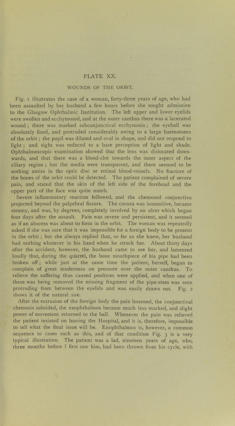 WOUNDS OF THE ORBIT. Fig. I illustrates the case of a woman, forty-three years of age, who had been assaulted by her husband a few hours before she sought admission to the Glasgow Ophthalmic Institution. The left upper and lower eyelids were swollen and ecchymosed, and at the outer canthus there was a lacerated wound ; there was marked subconjunctival ecchymosis ; the eyeball was absolutely fixed, and protruded considerably owing to a large haematoma of the orbit ; the pupil was dilated and oval in shape, and did not respond to light; and sight was reduced to a bare perception of light and shade. Ophthalmoscopic examination showed that the lens was dislocated down- wards, and that there was a blood-clot towards the inner aspect of the ciliary region ; but the media were transparent, and there seemed to be nothing amiss in the optic disc or retinal blood-vessels. No fracture of the bones of the orbit could be detected. The patient complained of severe pain, and stated that the skin of the left side of the forehead and the upper part of the face was quite numb. Severe inflammatory reaction followed, and the chemosed conjunctiva projected beyond the palpebral fissure. The cornea was insensitive, became steamy, and was, by degrees, completely involved by an ulcer which began four days after the assault. Pain was severe and persistent, and it seemed as if an abscess was about to form in the orbit. The woman was repeatedly- asked if she was sure that it was impossible for a foreign body to be present in the orbit ; but she always replied that, so far as she knew, her husband had nothing whatever in his hand when he struck her. About thirty days after the accident, however, the husband came to see her, and lamented loudly that, during the quarrel, the bone mouthpiece of his pipe had been broken off; while Just at the same time the patient, herself, began to complain of great tenderness on pressure over the outer canthus. To relieve the suffering thus caused poultices were applied, and when one of these was being removed the missing fragment of the pipe-stem was seen protruding from between the eyelids and was easily drawn out. Fig. 2 shows it of the natural size. After the extrusion of the foreign body the pain lessened, the conjunctival chemosis subsided, the exophthalmos became much less marked, and slight power of movement returned to the ball. Whenever the pain was relieved the patient insisted on leaving the Hospital, and it is, therefore, impossible to tell what the final issue will be. Enophthalmos is, however, a common sequence to cases such as this, and of that condition Fig. 3 is a very typical illustration. The patient was a lad, nineteen years of age, who, three months before I first saw him, had been thrown from his cycle, with