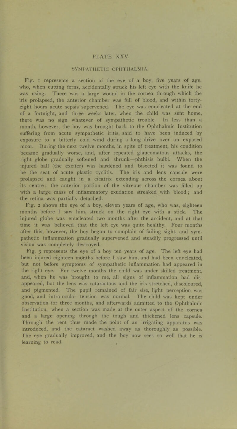 SYMPATHETIC OPHTHALMIA. Fig. I represents a section of the eye of a boy, five years of age, who, when cutting ferns, accidentally struck his left eye with the knife he was using. There was a large wound in the cornea through which the iris prolapsed, the anterior chamber was full of blood, and within forty- eight hours acute sepsis supervened. The eye was enucleated at the end of a fortnight, and three weeks later, when the child was sent home, there was no sign whatever of sympathetic trouble. In less than a month, however, the boy was brought back to the Ophthalmic Institution suffering from acute sympathetic iritis, said to have been induced by exposure to a bitterly cold wind during a long drive over an exposed moor. During the next twelve months, in spite of treatment, his condition became gradually worse, and, after repeated glaucomatous attacks, the right globe gradually softened and shrunk—phthisis bulbi. When the injured ball (the exciter) was hardened and bisected it was found to be the seat of acute plastic cyclitis. The iris and lens capsule were prolapsed and caught in a cicatrix extending across the cornea about its centre; the anterior portion of the vitreous chamber was filled up with a large mass of inflammatory exudation streaked with blood ; and the retina was partially detached. Fig. 2 shows the eye of a boy, eleven years of age, who was, eighteen months before I saw him, struck on the right eye with a stick. The injured globe was enucleated two months after the accident, and at that time it was believed that the left eye was quite healthy. Four months after this, however, the boy began to complain of failing sight, and sym- pathetic inflammation gradually supervened and steadily progressed until vision was completely destroyed. Fig. 3 represents the eye of a boy ten years of age. The left eye had been injured eighteen months before I saw him, and had been enucleated, but not before symptoms of sympathetic inflammation had appeared in the right eye. For twelve months the child was under skilled treatment, and, when he was brought to me, all signs of inflammation had dis- appeared, but the lens was cataractous and the iris stretched, discoloured, and pigmented. The pupil remained of fair size, light perception was good, and intra-ocular tension was normal. The child was kept under observation for three months, and afterwards admitted to the Ophthalmic Institution, when a section was made at the outer aspect of the cornea and a large opening through the tough and thickened lens capsule. Through the rent thus made the point of an irrigating apparatus was introduced, and the cataract washed away as thoroughly as possible. The eye gradually improved, and the boy now sees so well that he is learning to read. ,