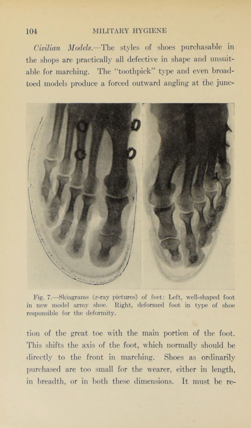 Civilian Models.—C\\it styles of shoes purchasable in the shops are practically all defective in shape and unsuit- able for inarching. The “toothpick” type and even broad- toed models produce a forced outward angling at the junc- Fiff. 7.—Skiaprams (.r-ray pictures) of foot; Loft, well-shaped foot in new model iirmy shoe. Right, deformed foot in type of shoe responsible for the deformity. tion of the great toe with the main portion of the foot. This shifts the axis of the foot, which normally should be din'ctly to the front in marching. Shoes as ordinarily ])urchased are too small for the wearer, either in length, in breadth, or in both these dimensions. It must be re-