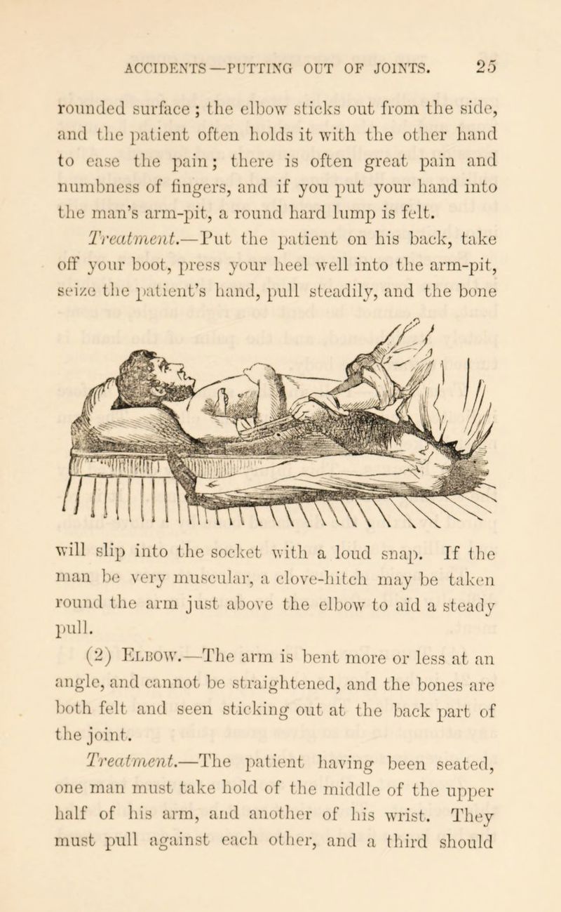 rounded surface ; the elbow sticks out from the side, and the patient often holds it with the other hand to ease the pain; there is often great pain and numbness of lingers, and if you put your hand into the man’s arm-pit, a round hard lumj:) is felt. Treatment.—Put the patient on his back, take otf your boot, press your heel well into the arm-pit, seize the patient’s hand, pull steadily, and the bone will slip into the soclmt with a loud snap. If the man l)e very muscular, a clovc-liitch may l^e taken round llie arm just above the elbow to aid a steady pull. (2) Eldow.—The arm is bent more or less at an angle, and cannot be straightened, and the bones are ])oth felt and seen sticking out at the back part of the joint. Ireatment.—The patient having been seated, one man must take hold of the middle of the upper half of his arm, and another of his wrist. They must pull against each other, and a third should