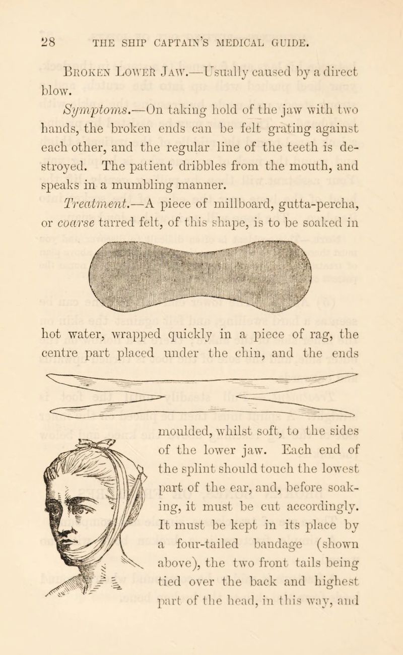 I’iiOKEN l^owEtl Jaw.—Usually caused by a direct %/ %/ l)lo^y. Symptoms.—On taking hold of the jaw with two hands, the broken ends can be felt grating against each other, and the regidar line of the teeth is de- stroyed. The patient dribbles from the mouth, and speaks in a mumbling manner. Treatment.—A piece of millboard, gutta-percha, or coarse tarred felt, of this shape, is to be soaked in hot water, wrapped quickly in a piece of rag, the centre part placed under the chin, and the ends moulded, whilst soft, to the sides of the lower jaw. Each end of the splint should touch the lowest [)art of the ear, and, before soak- ing, it must be cut accordingly. It must be kept in its place by a four-tailed bandage (shown aboye), the two front tails being tied oyer the back and highest part of the head, in this way, and