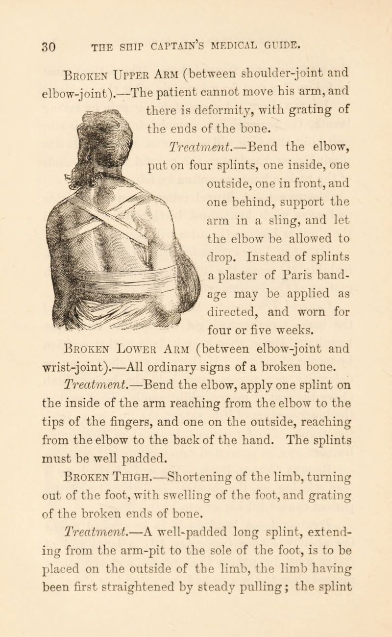 Broken Upper Arm (between shoulder-joint and elbow-joint).—The patient cannot move his arm, and there is deformity, with grating of the ends of the bone. Treatment.—Bend the elbow, put on four splints, one inside, one outside, one in front, and one behind, support the arm in a sling, and let the elbow be allowed to drop. Instead of splints a plaster of Paris band- age may be applied as directed, and worn for four or five weeks. Broken Lower Arm (between elbow-joint and wrist-joint).—All ordinary signs of a broken bone. Treatment.—Bend the elbow, apply one splint on the inside of the arm reaching from the elbow to the tips of the fingers, and one on the outside, reaching from the elbow to the back of the hand. The splints must be well padded. Broken Thigh.—Shortening of the limb, turning out of the foot, with swelling of the foot, and grating of the broken ends of bone. Treatment.—A well-padded long splint, extend- ing from the arm-pit to the sole of the foot, is to be placed on the outside of the limb, the limb having been first straightened by steady pulling; the splint