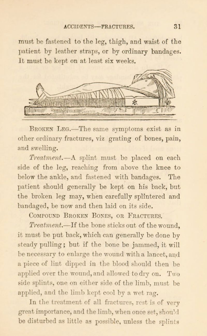 must be fastened to the leg, thigh, and waist of the patient by leather straps, or by ordinary bandages. It must be kept on at least six weeks. Broken T^eg.—The same symptoms exist as in other ordinary fractures, viz grating of bones, pain, and swelling. Treatment.—A splint must be placed on each side of the leg, reaching from above the knee to below the ankle, and fastened with bandages. The patient should generally be kept on his back, but the broken leg may, when carefully splintered and bandaged, be now and then laid on its side. Compound Broken Bones, or Fractures. Treatment.—If the bone sticks out of the wound, it must be put back, which can generally be done by steady pulling; but if the bone be jammed, it will he necessary to enlarge the wound with a lancet, and a piece of lint dip})ed in the blood should then be applied over the wound, and allowed to dry on. Two side splints, one on either side of the limb, must be applied, and the limb kept cool by a wet rag. In the treatment of all fractures, rest is of very great importance, and the limb, when once set, should be disturbed as little as possible, unless the splints