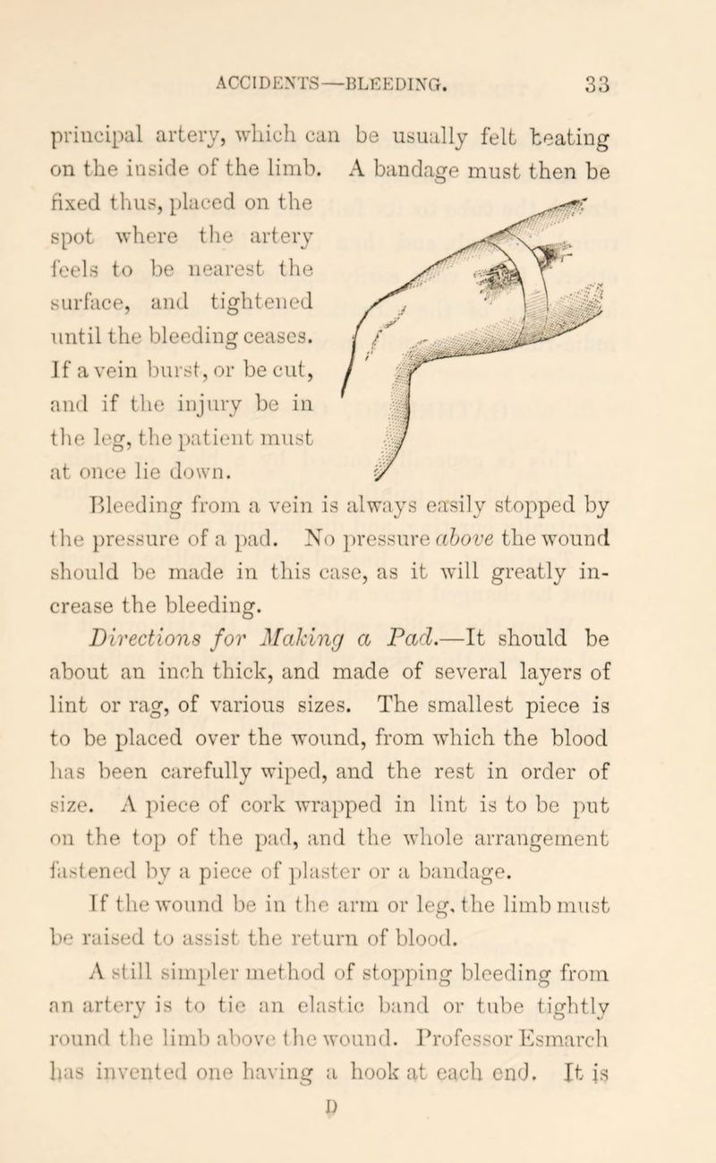 principal artery, which can be usually felt heating on the inside of the limb. A bandage must then be fixed thus, placed on the spot where the artery feels to be nearest the surface, and tightened until the bleeding ceases. If a vein l3urst,or be cut, and if the injury be in the leg, the patient must at once lie down. Bleeding from a vein is always easily stopped by the })ressure of a pad. No pressure above the wound should be made in this case, as it will greatly in- crease the bleeding. Directions for Making a Pad.—It should be about an inch thick, and made of several layers of lint or rag, of various sizes. The smallest piece is to be placed over the wound, from which the blood has been carefully wiped, and the rest in order of size. A piece of cork wrapped in lint is to be put on the top of the pad, and the whole arrangement fastened by a piece of i)laster or a bandage. If the wound be in the arm or leg, the limb must be raised to assist the return of blood. A still simpler method of stopping bleeding from an artery is to tie an elastic band or tube tightly round the limb above the wound. Professor Esmarch has invented one having a hook at each end. It is D
