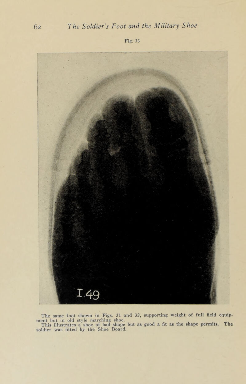 Fig. 33 The same foot shown in Figs. 31 and 32, supporting weight of full field equip- ment but in old style marching shoe. This illustrates a shoe of bad shape but as good a fit as the shape permits. The soldier was fitted by the Shoe Board.