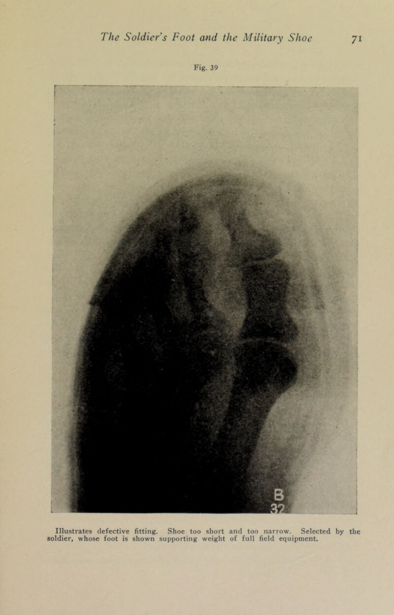 Fig. 39 Illustrates defective fitting. Shoe too short and too narrow. Selected by the