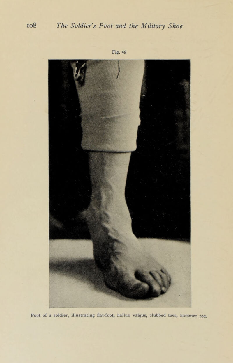 Fig. 48 Foot of a soldier, illustrating flat-foot, hallux valgus, clubbed toes, hammer toe.