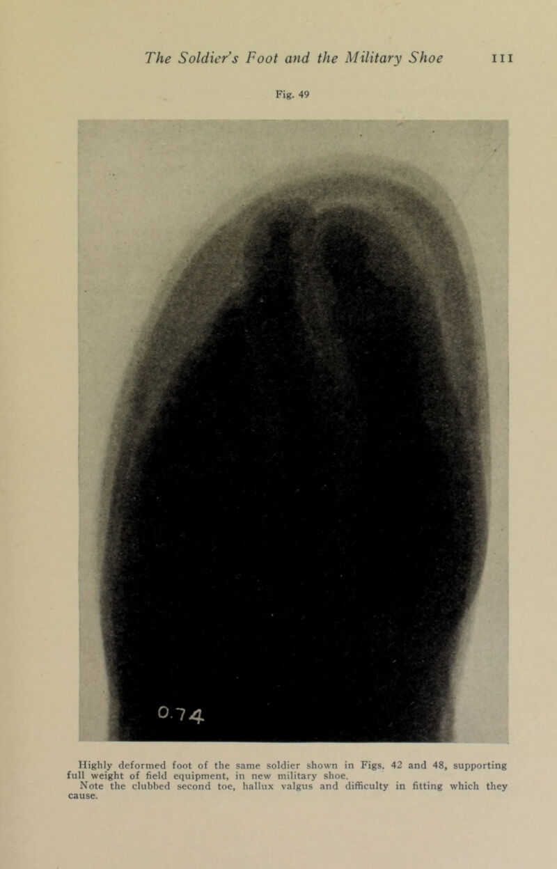 Fig. 49 Highly deformed foot of the same soldier shown in Figs. 42 and 48, supporting full weight of field equipment, in new military shoe. Note the clubbed second toe, hallux valgus and difficulty in fitting which they cause.