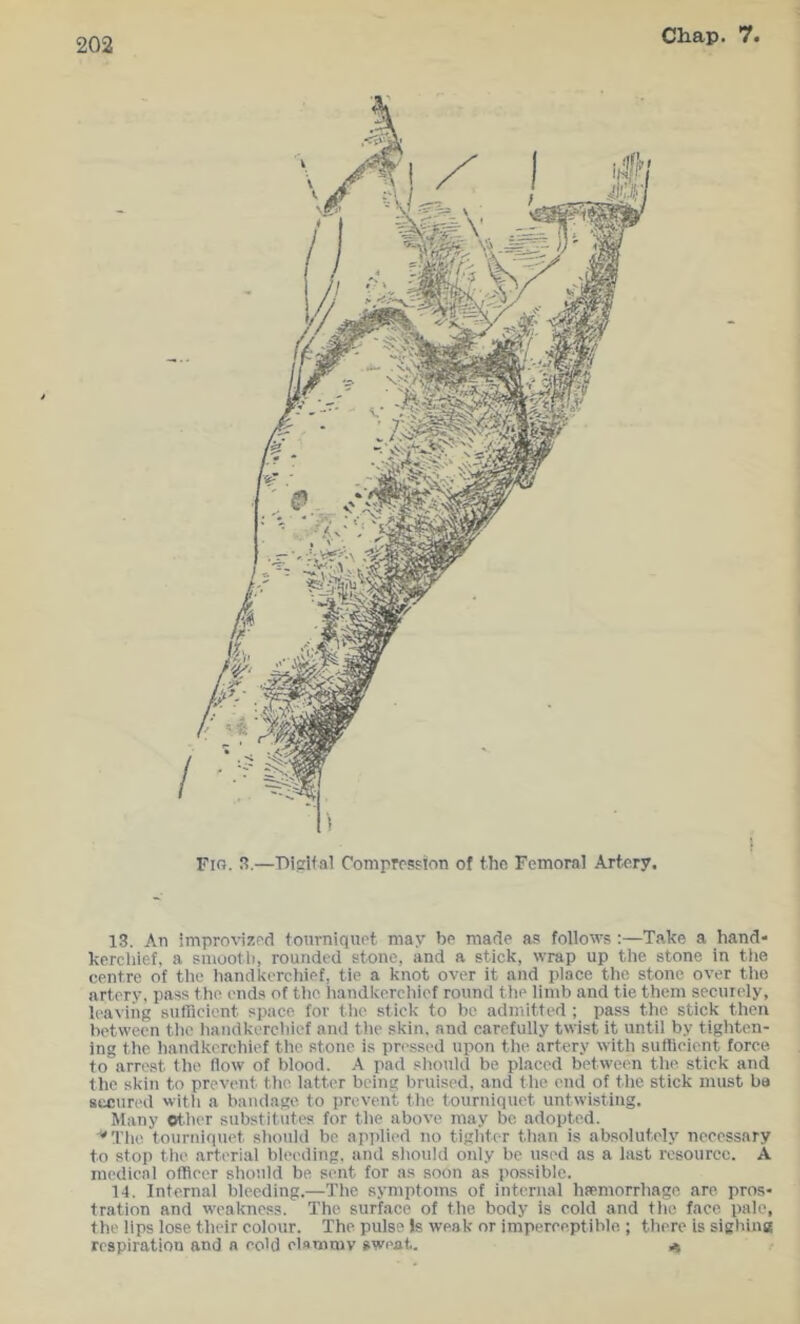 Fm. S.—Pifflfal Compression of the Femoral Artery. 13. An improvised tonrniquet may be made as follows :—Take a hand- kerchief, a sniootli, rounded stone, and a stick, wrap up the stone in tlie centre of the handkerchief, tie a knot over it and place the stone over the artery, pass the ends of the handkerchief round the limb and tie them securely, leaving sufficient space for the stick to be admitted; pass the stick then between the handkerchief and the skin, and carefully twist it until by tighten- ing the handkercliief the stone is pn'ssed upon the artery witli sufficient force to arrest the flow of blood. A pad should be placed between the stick and the skin to prevent the latter being bruised, and the end of the stick must ha secur(>d with a bandage to prevent the tourniquet untwisting. Many other substitutes for the above may be adopted. ^Tlie tourniquet should be applied no tigliter than is absolutely neeessary to stop the arterial bleeding, and sliould only be used as a last resource. A medical officer should be sent for as soon as possible. 14. Internal bleeding.—The symptoms of internal hfemorrhago are pros- tration and weakness. The surface of the body is cold and the face pale, the lips lose their colour. The pulse Js weak or imperceptible ; there is sighing respiration and a eohi elsmniv sweat.