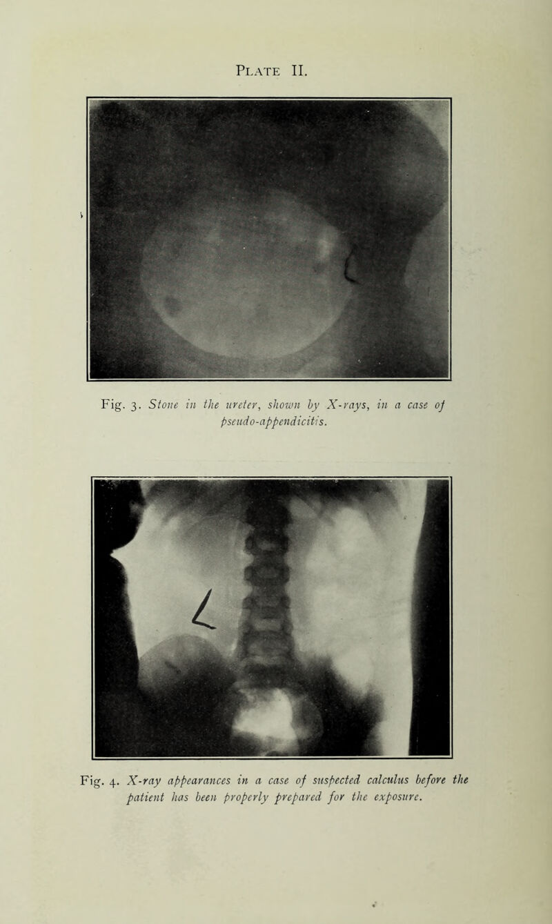 Fig. 3. Stone in the ureter, shown by X-rays, in a case 0/ pseudo-appendicitis. Fig. 4. X-ray appearances in a case of suspected calculus before the patient has been properly prepared for the exposure.