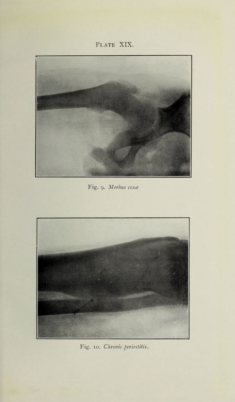 Fig. 9. Morbus coxa