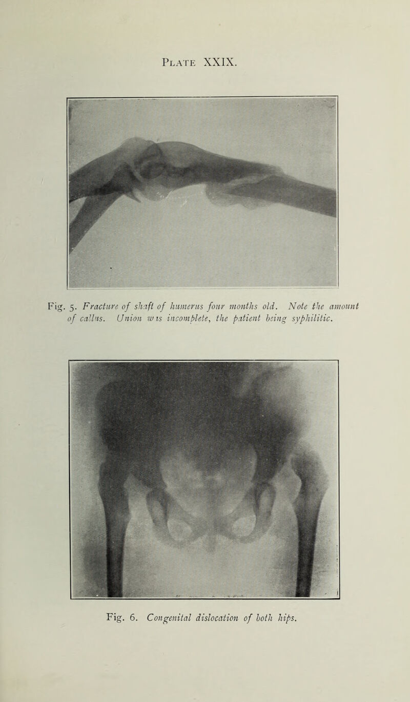 Fig. 5. Fracture of shaft of humerus four months old. Note the amount of callus. Union wis incomplete, the patient being syphilitic. Fig. 6. Congenital dislocation of both hips.