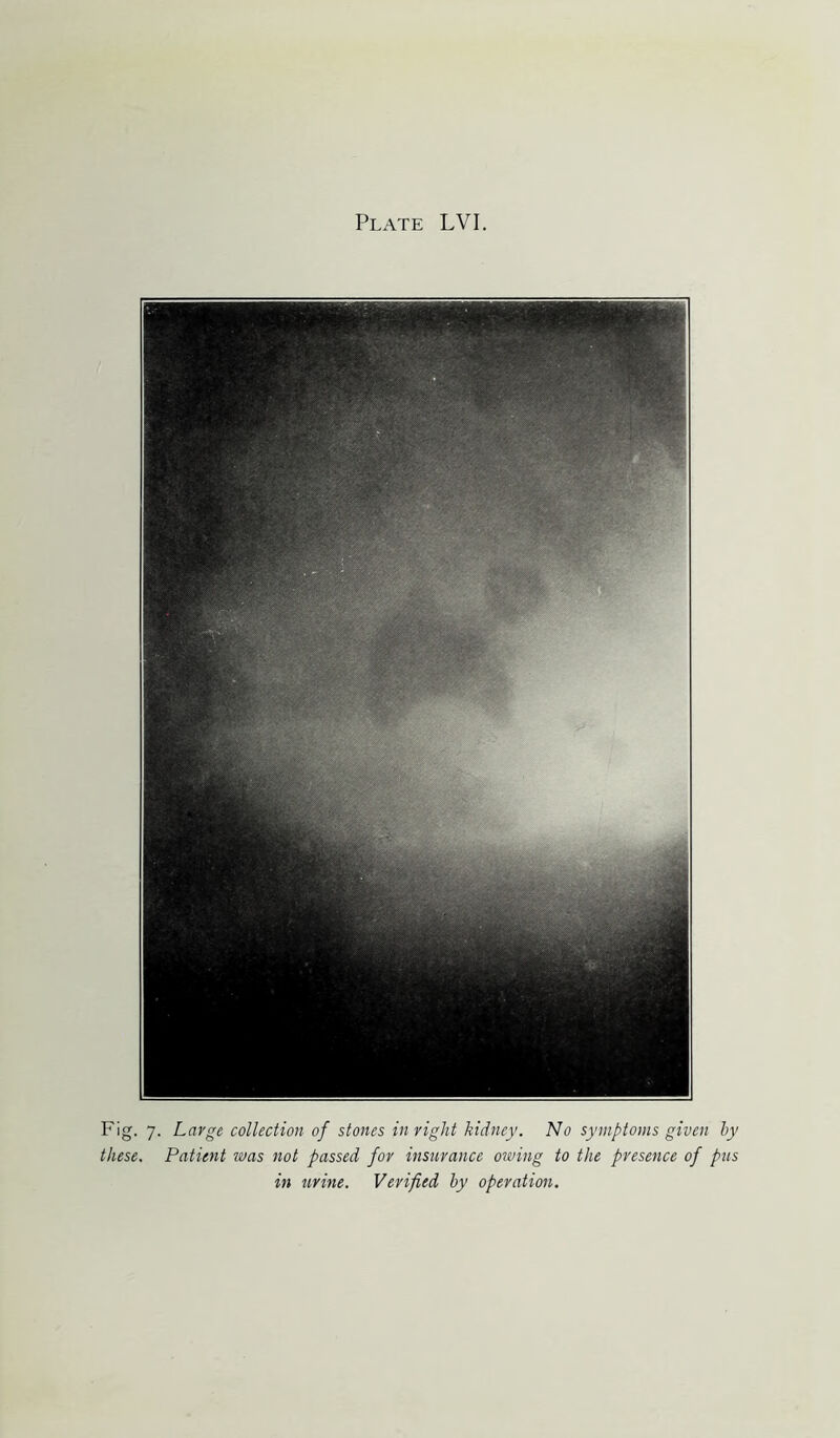 Fig. 7. Large collection of stones in right kidney. No symptoms given by these. Patient was not passed for insurance owing to the presence of pus in urine. Verified by operation.