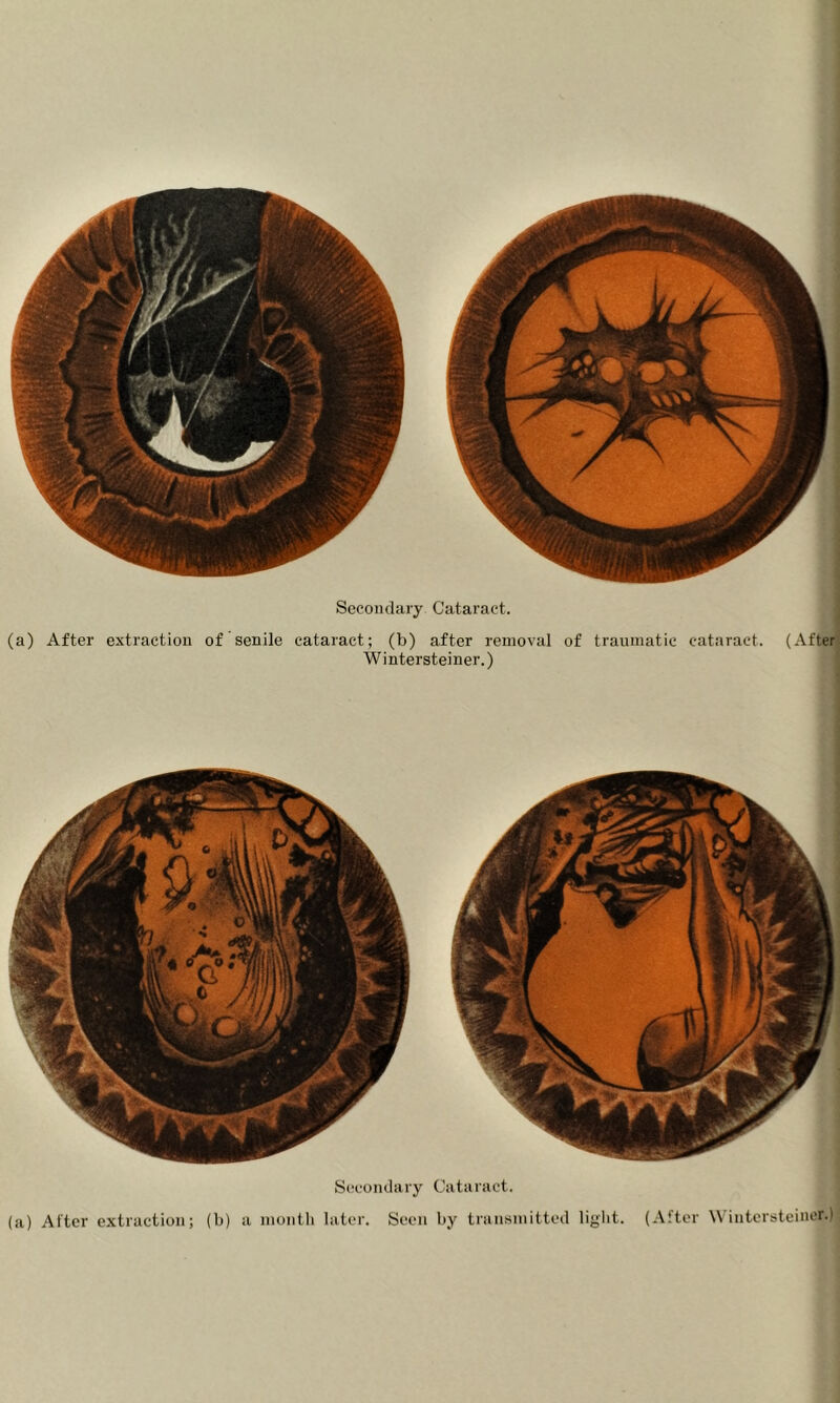 (a) After extraction of senile cataract; (b) after removal of traumatic cataract. (After Wintersteiner.) Secondary Cataract. (a) Alter extraction; (b) a moiitli later. Seen by transmitted light. (After Wintersteiner.)