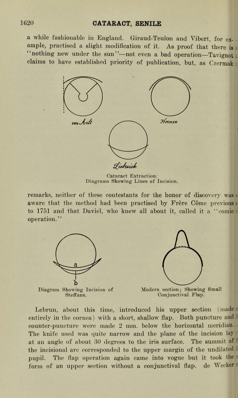 a while fashionable in England. Giraud-Teulon and Vibert, for ex- ample, practised a slight modification of it. As proof that there is < “nothing new nnder the sun”—not even a bad operation—Tavignot ; claims to have established priority of publication, but, as Czermak ; Cataract Extraction. Diagrams Showing Lines of Incision. remarks, neither of these contestants for the honor of discovery was - aware that the method had been practised by Prere Come previous s to 1751 and that Daviel, who knew all about it, called it a “comic? operation. ’ ’ Diagram Showing Incision of Stetfans. Modern section; Showing Small Conjunctival Flap. Lebrun, about this time, introduced his upper section ^ entirely in the cornea) with a short, shallow flap. Both puncture anti i counter-puncture were made 2 mm. below the horizontal meridian. The knife used was (piite narrow and the plane of the incision lay at an angle of about 30 degrees to the iris surface. The summit of t the incisional arc corresponded to the upper margin of the undilatetl ; pupil. The flap operation again came into vogue but it took the • form of an upper section without a conjunctival flap, de 'NVeoker '•