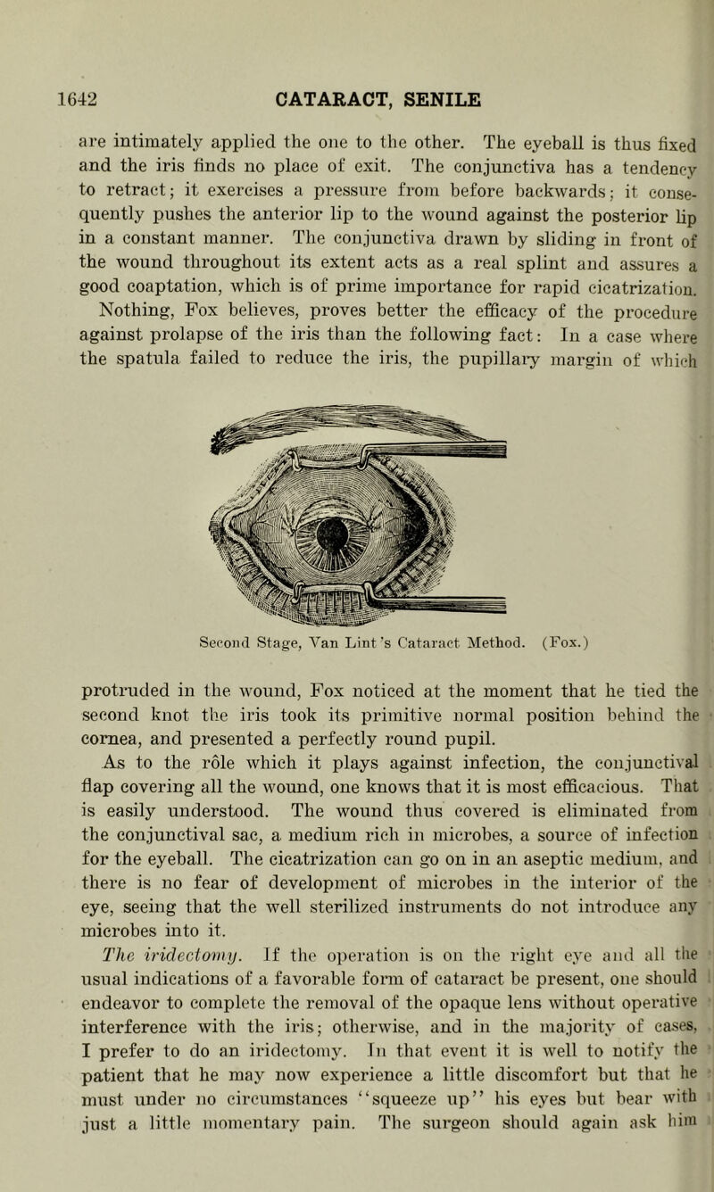 are intimately applied the one to the other. The eyeball is thus fixed and the iris finds no place of exit. The conjunctiva has a tendency to retract; it exercises a pressure from before backwards; it conse- quently pushes the anterior lip to the wound against the posterior lip in a constant manner. The conjunctiva drawn by sliding in front of the wound throughout its extent acts as a real splint and assures a good coaptation, which is of prime importance for rapid cicatrization. Nothing, Fox believes, proves better the efficacy of the procedure against prolapse of the iris than the following fact; In a case where the spatula failed to reduce the iris, the pupillaiy margin of which Second Stage, Van Lint's Cataract Method. (Fox.) proti’ucled in the wound. Fox noticed at the moment that he tied the second knot the iris took its primitive normal position behind the cornea, and presented a perfectly round pupil. As to the role which it plays against infection, the conjunctival flap covering all the wound, one knows that it is most efficacious. That is easily understood. The wound thus covered is eliminated from the conjunctival sac, a medium rich in microbes, a source of infection for the eyeball. The cicatrization can go on in an aseptic medium, and there is no fear of development of microbes in the interior of the eye, seeing that the well sterilized instruments do not introduce any microbes into it. The irideciomy. If the operation is on the right eye ami all The usual indications of a favorable fonn of cataract be present, one should endeavor to complete the removal of the opaque lens without operative interference with the iris; otherwise, and in the majority of cases, I prefer to do an iridectomy. In that event it is well to notify the patient that he maj^ now experience a little discomfort but that he must under no circumstances “squeeze up” his eyes but bear with just a little momentary pain. The surgeon should again ask him