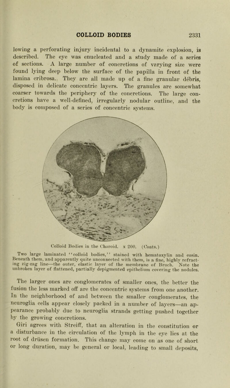 lowing a perforating injury incidental to a dynamite explosion, is described. The eye was enucleated and a study made of a series of sections. A large number of concretions of varying size Avere found lying deep beloAv the surface of the papilla in front of the lamina cribrosa. They are all made up of a fine granular debris, disposed in delicate concentric layers. The granules are somewhat coarser towards the periphery of the concretions. The large con- cretions have a well-defined, irregidarly nodular outline, and the body is composed of a series of concentric systems. Colloid Bodies in tlie Choroid, x 200. (Coats.) Two large laminated “colloid bodies,” stained with hematoxylin and eosin. Beneath them, and apparently quite unconnected with them, is a fine,' highly refract- ing zig-zag line—the outer, elastic layer of the membrane of Bruch. Note the unbroken layer of flattened, partially depigmented epithelium covering the nodules. The larger ones are conglomerates of smaller ones, the better the fusion the less marked off are the concentric systems from one another. In the neighborhood of and between the smaller conglomerates, the neuroglia cells appear closely packed in a number of layers—an ap- pearance probably due to neuroglia strands getting pushed together by the growing concretions. Giri agrees with Streiff, that an alteration in the constitution or a disturbance in the circulation of the lymph in the eye lies at the root of driisen formation. This change may come on as one of short or long duration, may be general or local, leading to small deposits,