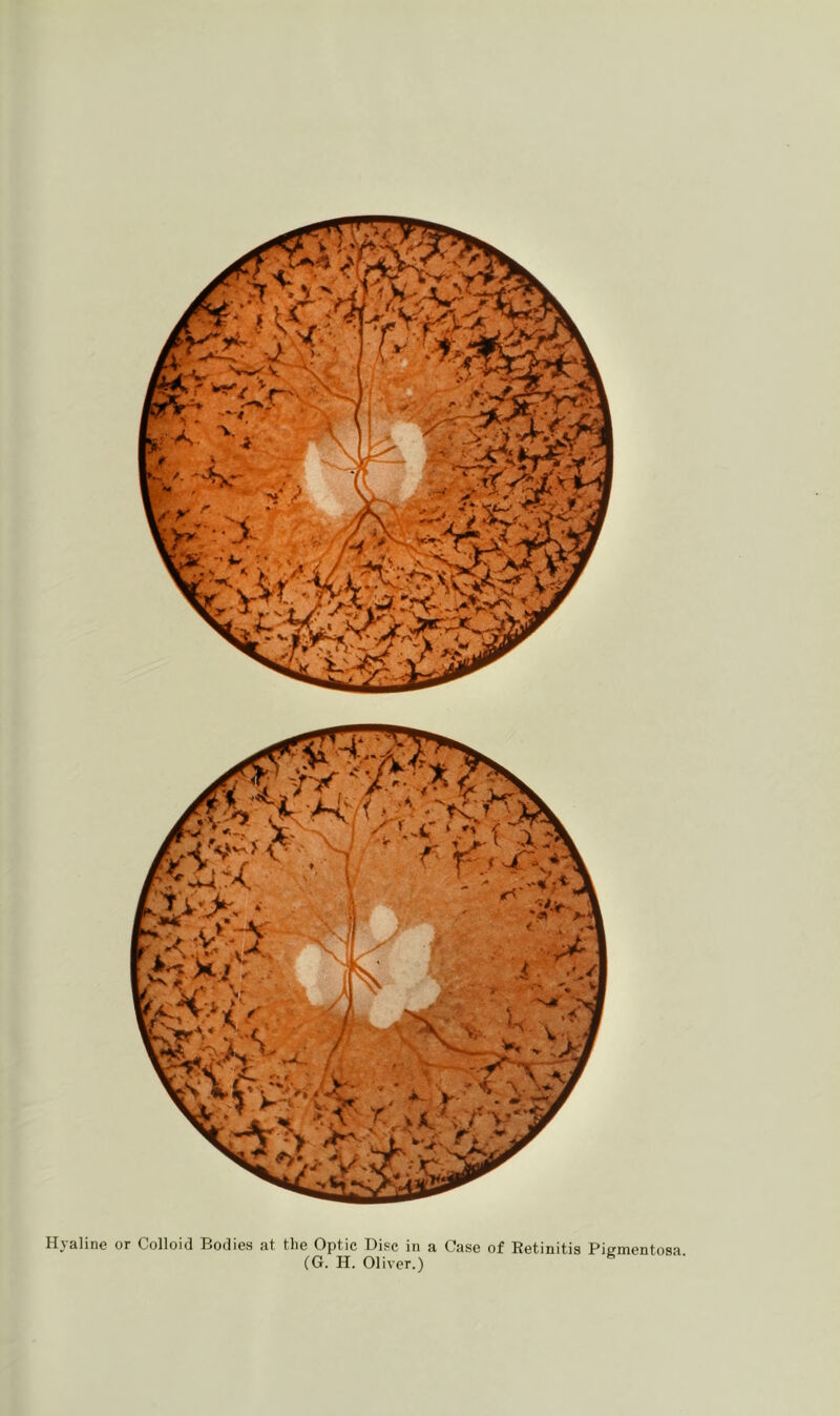 Hyaline or Colloid Bodies at the Optic Disc in a Case of Retinitis Pigmentosa (G. H. Oliver.) S