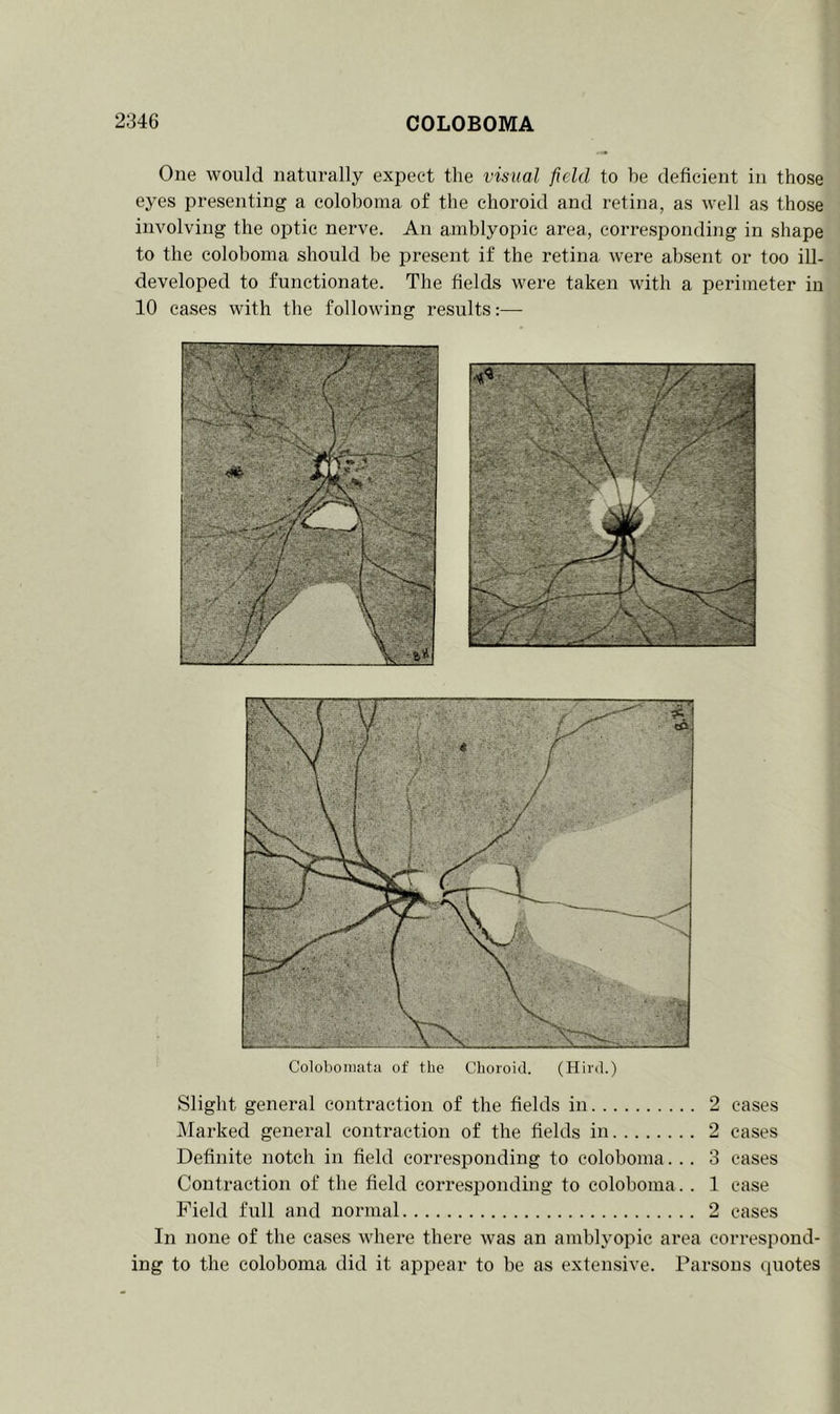 One would naturally expect the visual field to be deficient in those eyes presenting a coloboma of the choroid and retina, as well as those involving the optic nerve. An amblyopic area, corresponding in shape to the coloboma should be present if the retina were absent or too ill- developed to functionate. The fields were taken with a perimeter in 10 cases with the following results:— Colobomata of the Choroid. (Hird.) Slight general contraction of the fields in 2 cases Marked general contraction of the fields in 2 cases Definite notch in field corresponding to coloboma... 3 cases Contraction of the field corresponding to coloboma.. 1 ease Field full and normal 2 cases In none of the cases where there was an amblyopic area correspond- ing to the coloboma did it appear to be as extensive. Parsons quotes