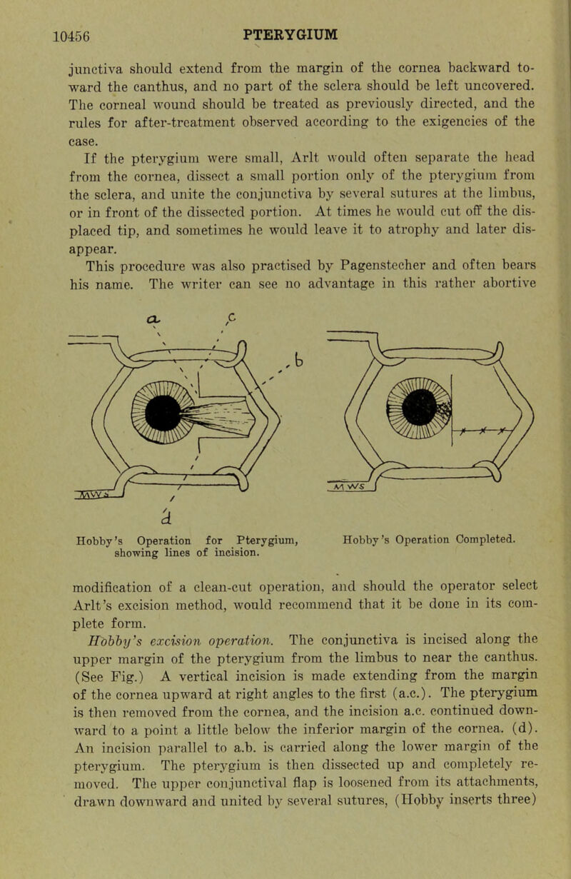 N. junctiva should extend from the margin of the cornea backward to- ward the canthus, and no part of the sclera should be left uncovered. The corneal wound should be treated as previously directed, and the rules for after-treatment observed according to the exigencies of the case. If the pterygium were small, Arlt would often separate the head from the cornea, dissect a small portion only of the pterygium from the sclera, and unite the conjunctiva by several sutures at the limbus, or in front of the dissected portion. At times he would cut off the dis- placed tip, and sometimes he would leave it to atrophy and later dis- appear. This procedure was also practised by Pagenstecher and often bears his name. The writer can see no advantage in this rather abortive a. ^ / Hobby’s Operation for Pterygium, showing lines of incision. Hobby’s Operation Completed. modification of a clean-cut operation, and should the operator select Arlt’s excision method, would recommend that it be done in its com- plete form. Hobby’s excision operation. The conjunctiva is incised along the upper margin of the pterygium from the limbus to near the canthus. (See Fig.) A vertical incision is made extending from the margin of the cornea upward at right angles to the first (a.c.). The pterygium is then removed from the cornea, and the incision a.c. continued down- ward to a point a little below the inferior margin of the cornea, (d). An incision parallel to a.b. is carried along the lower margin of the pterygium. The pterygium is then dissected up and completely re- moved. The upper conjunctival flap is loosened from its attachments, drawn downward and united by several sutures, (Hobby inserts three)