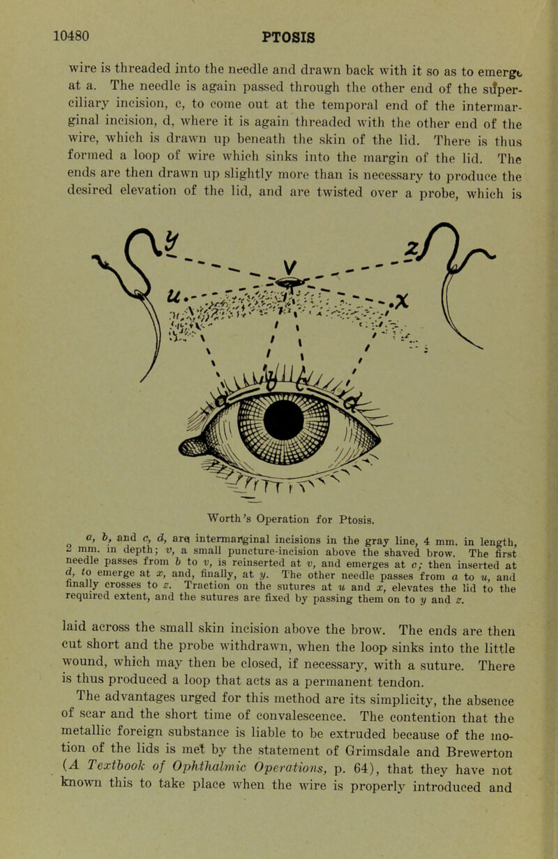 wire is threaded into the needle and drawn back with it so as to emergt at a. The needle is again passed through the other end of the siJper- ciliary incision, c, to come out at the temporal end of the intermar- ginal incision, d, where it is again threaded with the other end of the wire, which is drawn up beneath the skin of the lid. There is thus formed a loop of wire which sinks into the margin of the lid. The ends are then drawn up slightly more than is neces-sary to produce the desired elevation of the lid, and are twisted over a probe, which is Worth’s Operation for Ptosis. a, b, and e, d, arq intermartginal incisions in the gray line, 4 mm. in length, 2 imn. in depth; v, a small puncture-incision above the shaved brow. The first needle passes from b to v, is reinserted at v, and emerges at c; then inserted at a, 10 emerge at x, and, finally, at y. The other needle passes from a to u, and finally crosses to z. Traction on the sutures at u and x, elevates the lid to the required extent, and the sutures are fixed by passing them on to y and z. laid across the small skin incision above the brow. The ends are then cut short and the probe withdrawn, when the loop sinks into the little wound, which may then be closed, if necessary, with a suture. There is thus produced a loop that acts as a permanent tendon. The advantages urged for this method are its simplicity, the absence of scar and the short time of convalescence. The contention that the metellie foreign substance is liable to be extruded because of the mo- tion of the lids is met by the statement of Grimsdale and Brewerton {A Textbook of Ophthalmic Operations, p. 64), that they have not known this to take place when the wire is properly introduced and