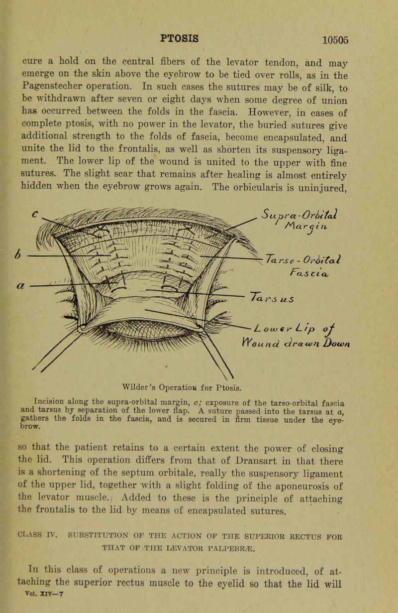 cure a hold on the central fibers of the levator tendon, and may emerge on the skin above the eyebrow to be tied over rolls, as in the Pagenstecher operation. In such cases the sutures may be of silk, to be withdrawn after seven or eight days when some degree of union has occurred between the folds in the fascia. However, in cases of complete ptosis, with no power in the levator, the buried sutures give additional strength to the folds of fascia, become encapsulated, and unite the lid to the frontalis, as well as shorten its suspensory liga- ment. The lower lip of the wound is united to the upper with fine sutures. The slight scar that remains after healing is almost entirely hidden when the eyebrow grows again. The orbicularis is uninjured. Wilder's Operation for Ptosis. Incision along the supra-orbital margin, o; exposure of the tarso-orbital fascia and tarsus by separation of the lower flap. A suture passed into the tarsus at a, gathers the folds in the fascia, and is secured in firm tissue under the eye- brow. SO that the patient retains to a certain extent the power of closing the lid. This operation differs from that of Dransart in that there is a shortening of the septum orbitale, really the suspensory ligament of the upper lid, together with a slight folding of the aponeurosis of the levator muscle. Added to these is the principle of attaching the frontalis to the lid by means of encapsulated sutures. CL.\SS IV. SUBSTITUTION OP THE ACTION OP THE SUPERIOR RECTUS POR THAT OP THE LEVATOR PALPEBR/E. In this class of operations a new principle is introduced, of at- taching the superior rectus muscle to the eyelid so that the lid will Vol. XIV—7