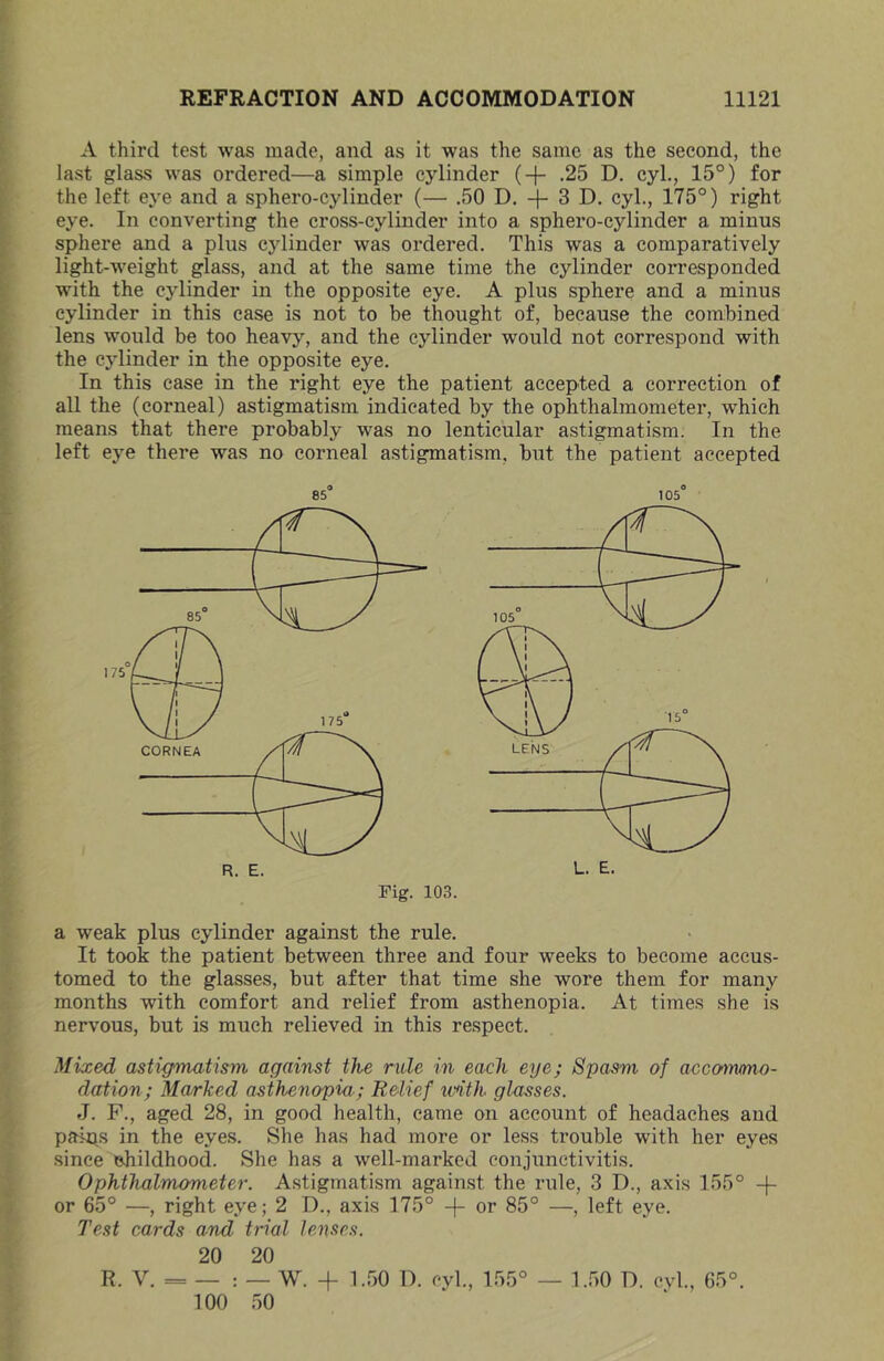 A third test was made, and as it was the same as the second, the last glass was ordered—a simple cylinder (+ .25 D. cyl., 15°) for the left eye and a sphero-cylinder (— .50 D. -j- 3 D. cyl., 175°) right eye. In converting the cross-cylinder into a sphero-cylinder a minus sphere and a plus cylinder was ordered. This was a comparatively light-weight glass, and at the same time the cylinder corresponded with the cylinder in the opposite eye. A plus sphere and a minus cylinder in this ease is not to be thought of, because the combined lens would be too heavy, and the cylinder would not correspond with the cylinder in the opposite eye. In this ease in the right eye the patient accepted a correction of all the (corneal) astigmatism indicated by the ophthalmometer, which means that there probably was no lenticular astigmatism. In the left eye there was no corneal astigmatism, but the patient accepted o 0 85 105 Fig. 103. a weak plus cylinder against the rule. It took the patient between three and four weeks to become accus- tomed to the glasses, but after that time she wore them for many months with comfort and relief from asthenopia. At times she is nervous, but is much relieved in this respect. Mixed astigmatism against the rule in each eye; Spasm of accommo- dation; Marked asthenopia; Relief with glasses. J. F., aged 28, in good health, came on account of headaches and paips in the eyes. She has had more or less trouble with her eyes since childhood. She has a well-marked conjunctivitis. Ophthalmometer. Astigmatism against the rule, 3 D., axis 155° -f- or 65° —, right eye; 2 D., axis 175° -(- or 85° —, left eye. Test cards and trial lenses. 20 20 R. V. = — : — W. + 1.50 D. cyl., 155° — 1.50 D. cyl., 65°. 100 50