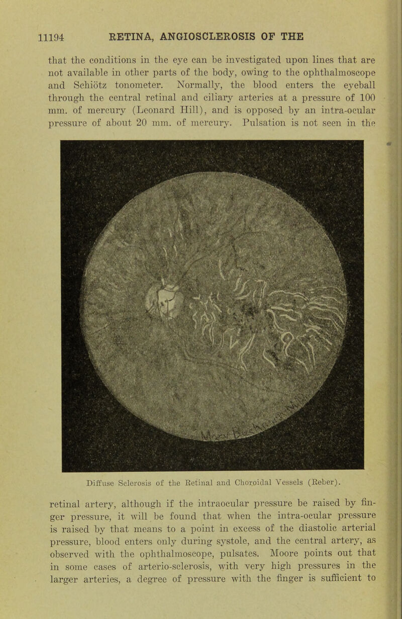 that the conditions in the eye can be investigated upon lines that are not available in other parts of the body, owing to the ophthalmoseope and Schiotz tonometer. Normally, the blood enters the eyeball tlirongh the central retinal and ciliarj^ arteries at a pressure of 100 mm. of mercury (Leonard Hill), and is opposed by an intra-ocular pressure of about 20 mm. of mercury. Pulsation is not seen in the Diffuse Sclerosis of the Retinal and Choroidal Vessels (Eeber). retinal artery, although if the intraocular pressure be raised by fin- ger pressure, it will he found that when the intra-ocular pressure is raised by that means to a point in excess of the diastolic arterial pressure, blood enters only during systole, and the central artery, as observed with the ophthalmoscope, pulsates. Moore points out that in some cases of arterio-sclerosis, vdth very high pressures in the larger arteries, a degree of pressure with the finger is sufficient to