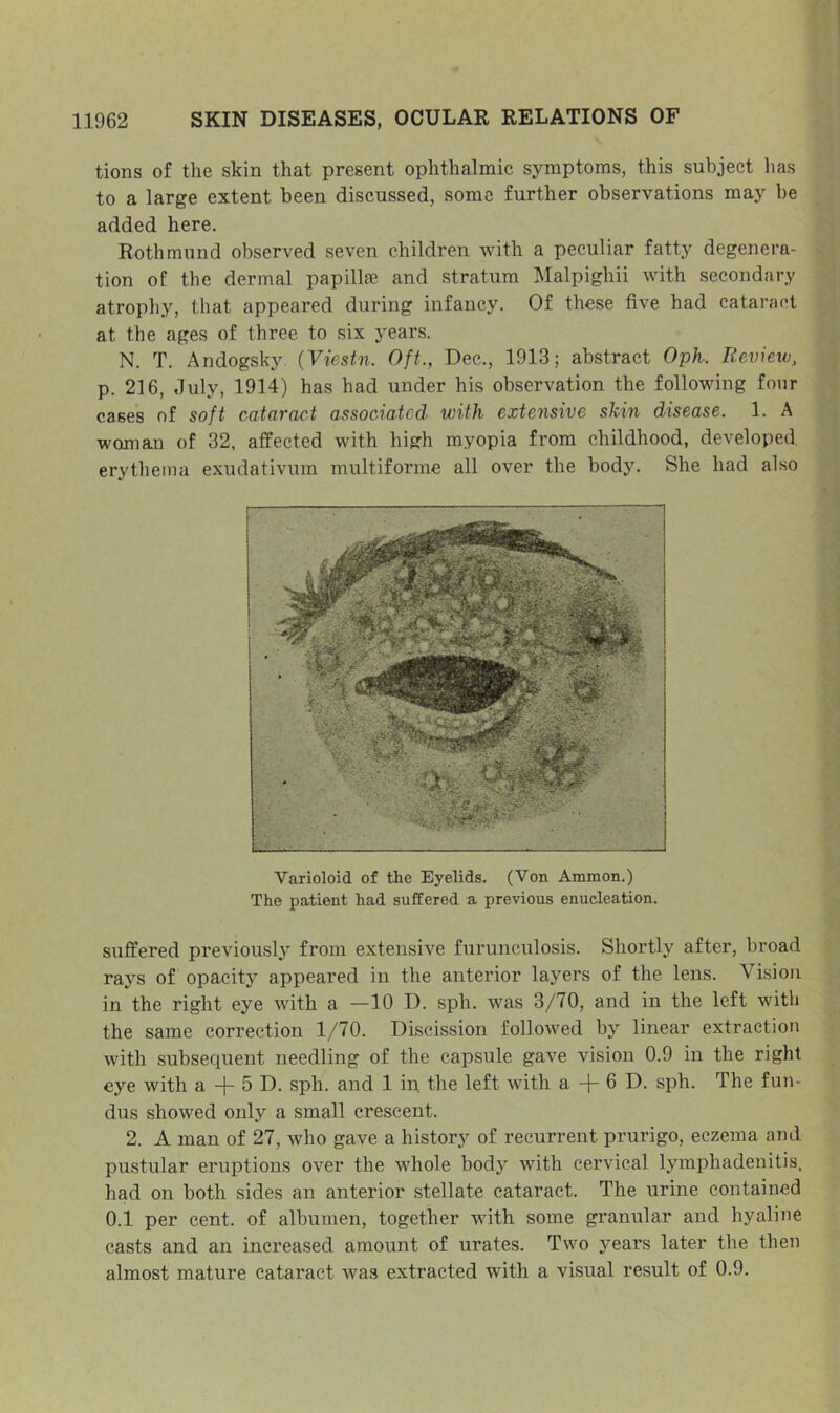 tions of the skin that present ophthalmic symptoms, this subject has to a large extent been discussed, some further observations may be added here. Rothmund observed seven children with a peculiar fatty degenera- tion of the dermal papillae and stratum Malpighii with secondary atrophy, that appeared during infancy. Of these five had cataract at the ages of three to six years. N. T. Andogsky {Yiestn. Oft., Dec., 1913; abstract OpK. Review, p. 216, July, 1914) has had under his observation the following four cases of soft cataract associated with extensive shin disease. 1. A woman of 32, affected with high myopia from childhood, developed erythema exudativum multiforme all over the body. She had also Varioloid of the Eyelids. (Von Ammon.) The patient had suffered a previous enucleation. suffered previously from extensive furunculosis. Shortly after, broad rays of opacity appeared in the anterior layers of the lens. Vision in the right eye with a —10 D. sph. was 3/70, and in the left with the same correction 1/70. Discission followed by linear extraction with subsequent needling of the capsule gave vision 0.9 in the right eye with a + 5 D. sph. and 1 in the left with a -f 6 D. sph. The fun- dus showed only a small crescent. 2. A man of 27, who gave a history of recurrent prurigo, eczema and pustular eruptions over the whole body with cervical lymphadenitis, had on both sides an anterior stellate cataract. The urine contained 0.1 per cent, of albumen, together with some granular and hyaline casts and an increased amount of urates. Two years later the then almost mature cataract was extracted with a visual result of 0.9.