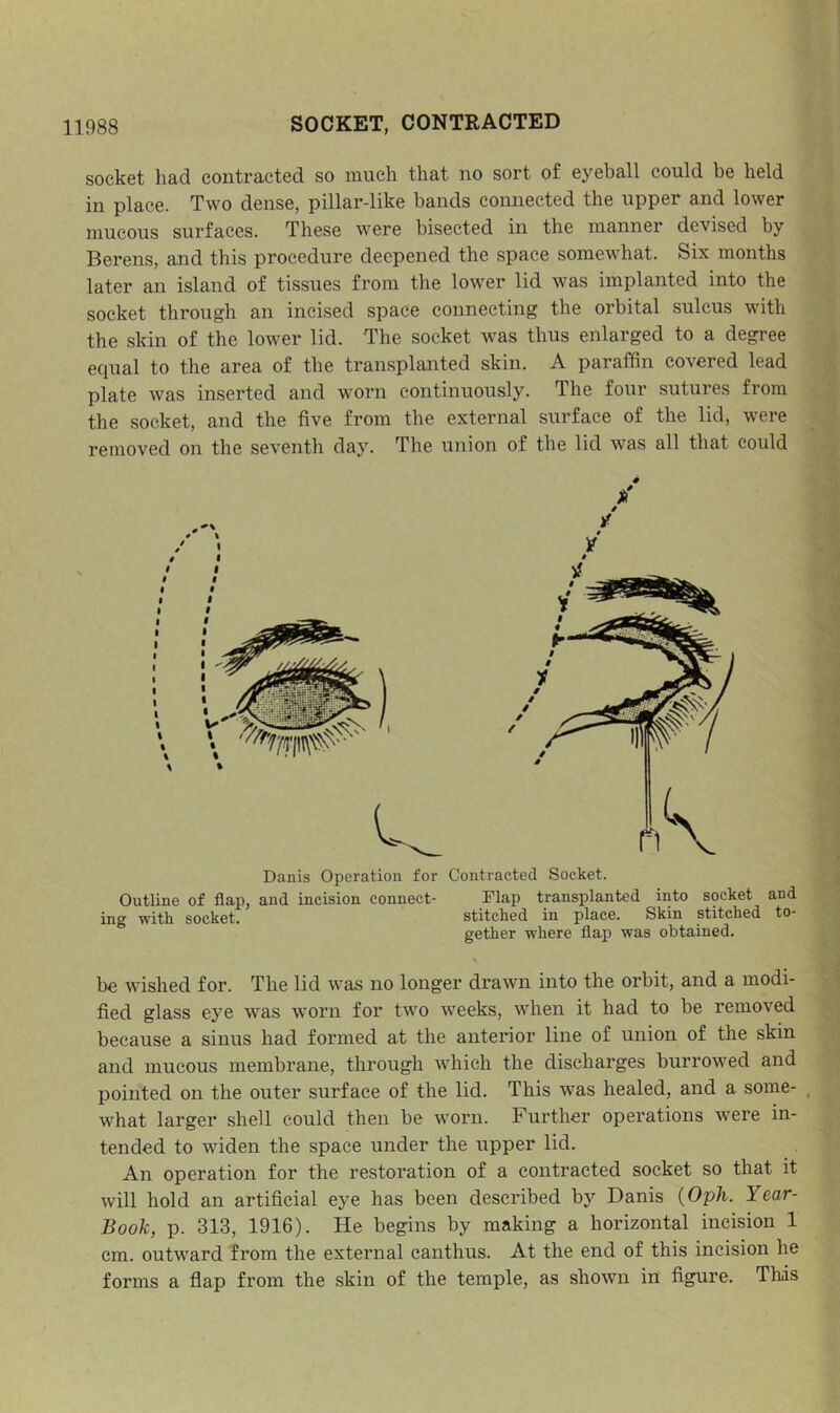 socket had contracted so much that no sort of eyeball could be held in place. Two dense, pillar-like bands connected the upper and lower mucous surfaces. These were bisected in the manner devised by Berens, and this procedure deepened the space somewhat. Six months later an island of tissues from the lower lid was implanted into the socket through an incised space connecting the orbital sulcus with the skin of the lower lid. The socket was thus enlarged to a degree equal to the area of the transplanted skin. A paraffin covered lead plate was inserted and worn continuously. The four sutures from the socket, and the five from the external surfaee of the lid, were removed on the seventh day. The union of the lid was all that could Danis Operation for Contracted Socket. Outline of flap, and incision connect- Flap transplanted into socket and ing with socket. stitched in place. Skin stitched to- gether where flap was obtained. be wished for. The lid was no longer drawn into the orbit, and a modi- fied glass eye was worn for two weeks, when it had to be removed beeause a sinus had formed at the anterior line of union of the skin and mucous membrane, through which the discharges burrowed and pointed on the outer surfaee of the lid. This was healed, and a some- , what larger shell could then be worn. Further operations were in- tended to widen the space under the upper lid. An operation for the restoration of a contracted socket so that it will hold an artificial eye has been described by Danis {Oph. Year- Book, p. 313, 1916). He begins by making a horizontal incision 1 cm. outward from the external canthus. At the end of this incision he forms a flap from the skin of the temple, as shown in figure. This