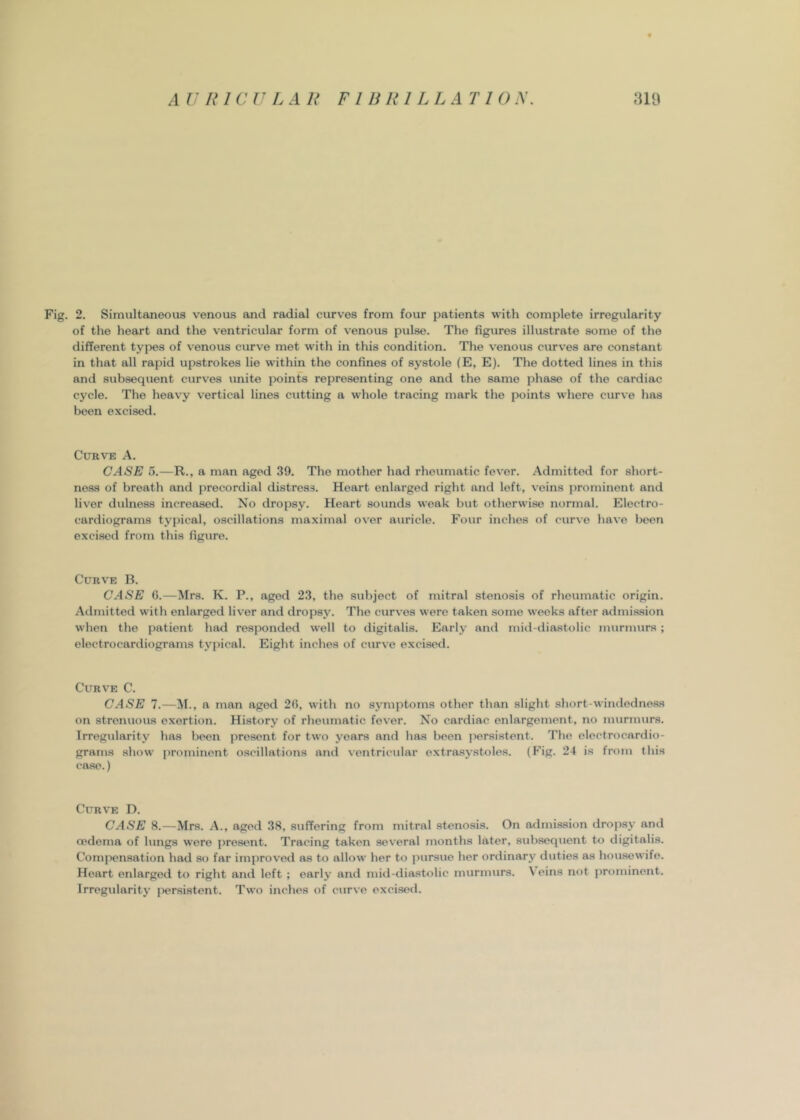 Fig. 2. Simultaneous venous and radial curves from four patients with complete irregularity of the heart and the ventricular form of venous pulse. The figures illustrate some of the different types of venous curve met with in this condition. The venous curves are constant in that all rapid upstrokes lie within the confines of systole (E, E). The dotted lines in this and subsequent curves unite points representing one and the same phase of the cardiac cycle. The heavy vertical lines cutting a whole tracing mark the points where curve has been excised. Curve A. CASE 5.—R., a man aged 39. The mother had rheumatic fever. Admitted for short- ness of breath and precordial distress. Heart enlarged right and left, veins prominent and liver dulness increased. No dropsy. Heart sounds weak but otherwise normal. Electro- cardiograms typical, oscillations maximal over auricle. Four inches of curve have been excised from this figure. Curve B. CASE 6.—Mrs. K. P., aged 23, the subject of mitral stenosis of rheumatic origin. Admitted with enlarged liver and dropsy. The curves were taken some weeks after admission when the patient had responded well to digitalis. Early and mid diastolic murmurs ; electrocardiograms typical. Eight inches of curve excised. Curve C. CASE 7.—M., a man aged 2(5, with no symptoms other than slight short-windedness on strenuous exertion. History of rheumatic fever. No cardiac enlargement, no murmurs. Irregularity has been ])rosent for two years and has been persistent. The electrocardio- grams show prominent oscillations and ventricular extrasystoles. (Fig. 24 is from this ca.se.) Curve D. CASE 8.—Mrs. A., aged 38, suffering from mitral stenosis. On admission dropsy and oedema of lungs were j)resent. Tracing taken several months later, subsequent to digitalis. Compensation had so far improved as to allow her to ]>ursue her ordinary duties as housewife. Heart enlarged to right and left ; early and mid-diastolic murmurs. V eins not prominent. Irregularity persistent. Two inches of curve excised.