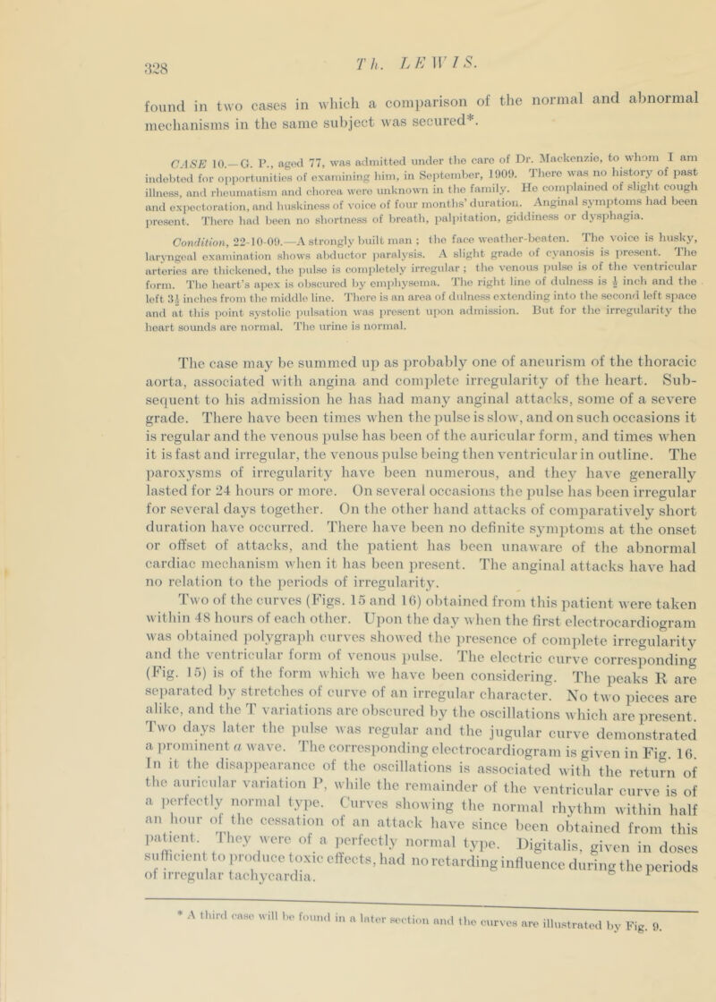 found in two cases in wliich a comparison of the normal and abnormal mechanisms in the same sid)ject was secured*. CASE 10.—G. P., agod 77, was admitted under the care of Dr. IMackenzio, to whom I am indebted for oi)i)ortunitio.s of examining him, in September, 1900. There was no history of past illness, and rhemnatism and ehorea were unknown in the fannlJ^ Ho complained of shglit cough and expectoration, and huskiness of voice of four months’ duration. Anginal symptoms had been present. There had been no shortness of breath, paliiitation, giddiness or dysphagia. Condition, 22-10-09.—A strongly built man ; the face weather-beaten. The voice is husky, laryngeal examination shows abductor ])aralysi.s. A slight grade of evanosis is present, dhe arteries are thickened, the jndse is completely irn^gular ; the venous jiulse i.s of the \entiicular form. The heart’s apex is obscured by emphysema. The right line of dulness is J incli and the left :H inches from the middle line. There is an area of dulness extending into the second left space and at this point systolic imlsation was present upon admission. But for the irregularity the heart soimds are normal. The urine is normal. The case may be summed up as probably one of aneurism of the thoracic aorta, associated with angina and complete irregularity of the heart. Sub- sequent to his admission he has had many anginal attacks, some of a severe grade. There have been times w hen the pulse is slow, and on such occasions it is regular and the venous pulse has been of the auricular form, and times wdien it is fast and irregular, the venous pulse being then ventricular in outline. The paroxysms of irregularity have been numerous, and they have generally lasted for 24 hours or more. On several occasions the pulse has been irregular for several days together. On the other hand attacks of comparatively short duration have occurred. There have been no definite symptoms at the onset or offset of attacks, and the patient has been unaware of the abnormal cardiac mechanism when it has been present. The anginal attacks have had no relation to the ])eriods of irregularity. dhvo of the curves (Figs. 15 and IG) obtained from this patient were taken within 48 hours of each other. Upon the day when the first electrocardiogram was obtained ])olygraph curves showed the ])resence of complete irregularity and the ventricular form of venous pulse. The electric curve corresponding (Fig. 15) is of the form which Ave have been considering. The peaks R are se])arated by stretches of curve of an irregular character. No two pieces are alike, and the T variations are obscured by the oscillations which are present. Two days later the pidse was regular and the jugular curve demonstrated a ])i ominent (i w a\ e. I he corresponding electrocardiogram is given in Fig. 16 In it the disaiipearancc of the oscillations is associated with the return of the auricular variation P, while the remainder of the ventricular curve is of a ])erfectly normal type. Curves showing the normal rhythm within half an linin' ot the cessation of an attack have since been obtained from this ,.a lent 1 hey Mere of a perfectly normal tyjte. Digitalis, given in doses suHieient to produce toxic eftects, had no retarding influence during the periods of irregular tachycardia. ^ ♦ A tliinl caso will b,> ftniiul in a later seelitm aiul the curves are illustrated by Fig. 9.