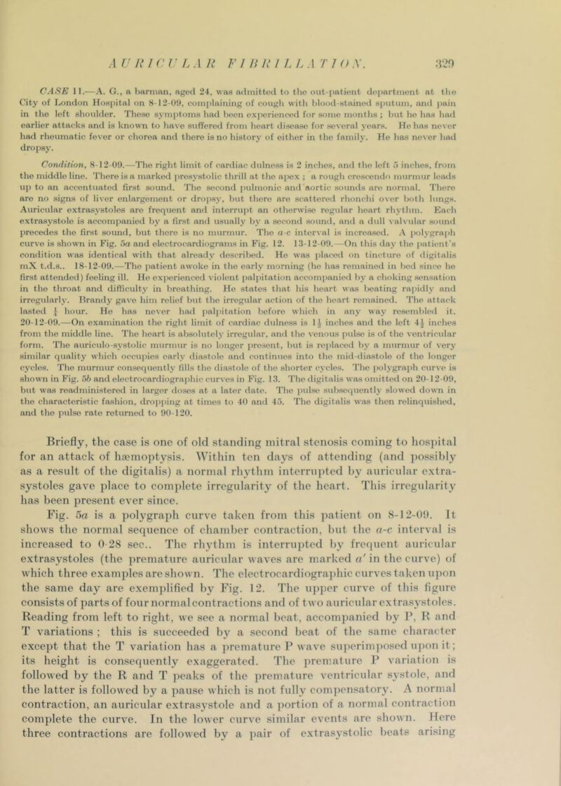 CASE 11.—A. G., a barman, aged 24, v.a.s admitted to the out-patient department at the City of London Hospital on S-12-0!), comi)laining of cough with hlood-.stained sputum, and j)ain in the left shoulder. These symptoms had been experienced for some months ; hut ho has ha<l earlier attacks and is known to have suffered from heart disease for several years. He has never hatl rheumatic fever or chorea and there is no history of either in the family. He has never had dropsy. Condition, 8-12-09.—The right limit of cardiac dulnoss is 2 inches, and the left 5 inches, from the middle line. There is a marked pro.systolic thrill at the apex ; a rough crescendo murmur letwls up to an accentuated first sound. The second pulmonic and'aortic sounds are normal. There are no signs of liver enlargement or dro|)sy, hut there are scattered rhonchi over both lungs. Auricular extrasystoles are frequent and interrupt an otherwise regular heart rhythm. Each extrasystole is accompanied by a first and usually by a second sound, and a dull valvular sound precedes the first sound, but there is no murmur. The a-c interval is increa.sed. A iiolygraph curve is shown in Fig. oa and electrocardiograms in Fig. 12. 13-12-09.—On this day the patient’s condition was identical with that already described. Ho was placed on tincture of digitalis mX t.d.s.. 18-12-09.—The patient awoke in the early morning (he has remained in bed since he first attended) feeling ill. He experienced violent pal[)itation accompanied by a choking .sensation in the throat and difficulty in breathing. He states that his heart was beating ra[)idly and irregularly. Brandy gave him relief but the irregular action of the heart remained. The attack lasted I hour. He has never had j)al{)itation before which in any way resembled it. 20-12-09.—On examination the right limit of cardiac dulness is li inches and the left inches from the middle line. The heart is absolutely irregular, and the venous pulse is of the ventricular form. The auriculo-systolic murmur is no longer present, l)ut is replaced by a nmrmur of very similar quality which occu[)ies early diastole and continues into the mid-diastole of the longer cycles. The murmur consequently fills the diastole of the shorter cycles. The j)olygraph curve is shown in Fig. 56 and electrocardiographic curves in Fig. 13. The digitalis was omitted on 20-12-09, but was readministered in larger doses at a later date. The i)ulse subsequently slowed down in the characteristic fashion, dropping at times to 40 and 45. The digitalis was then relinquished, and the puLse rate returned to 90-120. Briefly, the case is one of old standing mitral stenosis coming to hospital for an attack of haemoptysis. Within ten days of attending (and ])ossil)ly as a result of the digitalis) a normal rhythm interrujited by auricular extra- systoles gave place to complete irregularity of the heart. This irregularity has been present ever since. Fig. 5a is a polygraph curve taken from this patient on 8-12-09. It shows the normal sequence of chamber contraction, but the a-c interval is increased to 0-28 sec.. The rhythm is interrupted by frequent auricular extrasystoles (the premature auricular waves are marked a' in the curve) of which three examples are shown. The electrocardiographic curves taken upon the same day are exemplified by Fig. 12. The upper curve of this figure consists of parts of four normal contractions and of two auricular extrasystoles. Reading from left to right, we see a normal beat, accompanied by P, R and T variations ; this is succeeded bv a second beat of the same character except that the T variation has a ])remature P wave su])erim])osed u])on it; its height is consequently exaggerated. The ])rem.ature P variation is followed by the R and T jfeaks of the premature ventricular systole, and the latter is followed by a pause which is not fully com])ensatory. A normal contraction, an auricular extrasystole and a portion of a normal contraction complete the curve. In the lower curve similar events are shown. Here three contractions are followed by a pair of extrasystolic beats arising