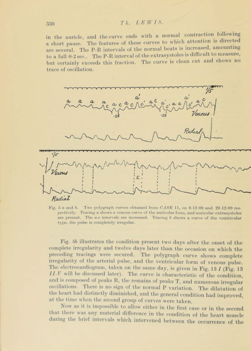 aao in the auricle, and the curve ends with a normal contraction following a short pause. The features of these curves to which attention is directed are several. The P-R intervals of the normal beats is increased, amounting to a full 0-2 sec.. The P-R interval of the extrasystoles is difficult to measure, but certainly exceeds this fraction. The curve is clean cut and shows no trace of oscillation. 'A- Fig. i) a and h. Two polygraph curves obtained from CASE 11, on 8-12-09 and 20-12-09 res- l)octively. Tracing a shows a venous curve of the auricular form, and auricvdar extrasystoles are present. Tlie a-c iirtervals are increased. Tracing b shows a cvirve of the ventricular tyj)c, the pulse is completely irregular. Fig. 5& illustrates the condition present two days after the onset of the complete irregularity and twelve days later than the occasion on which the jireceding tracings were secured. The polygraph curve shows complete irregularity of the arterial judse, and the ventricular form of venous pulse. The electrocardiogram, taken on the same day, is given in Fig. 13 1 (Fig. 13 11V ill be discussed later). The cur^'e is eharacteristic of the condition, and is com])oseci of ])eaks R, the remains of peaks T, and numerous irregular oscillations. There is no sign of the normal P variation. The dilatation of the heart had distinctly diminished, and the general condition had improved, at the time when the second grou]) of curves were taken. Now as it is imimssible to allow either in the first case or in the second that there was any material difference in the condition of the heart muscle dining the brief intervals which intervened between the occurrence of the